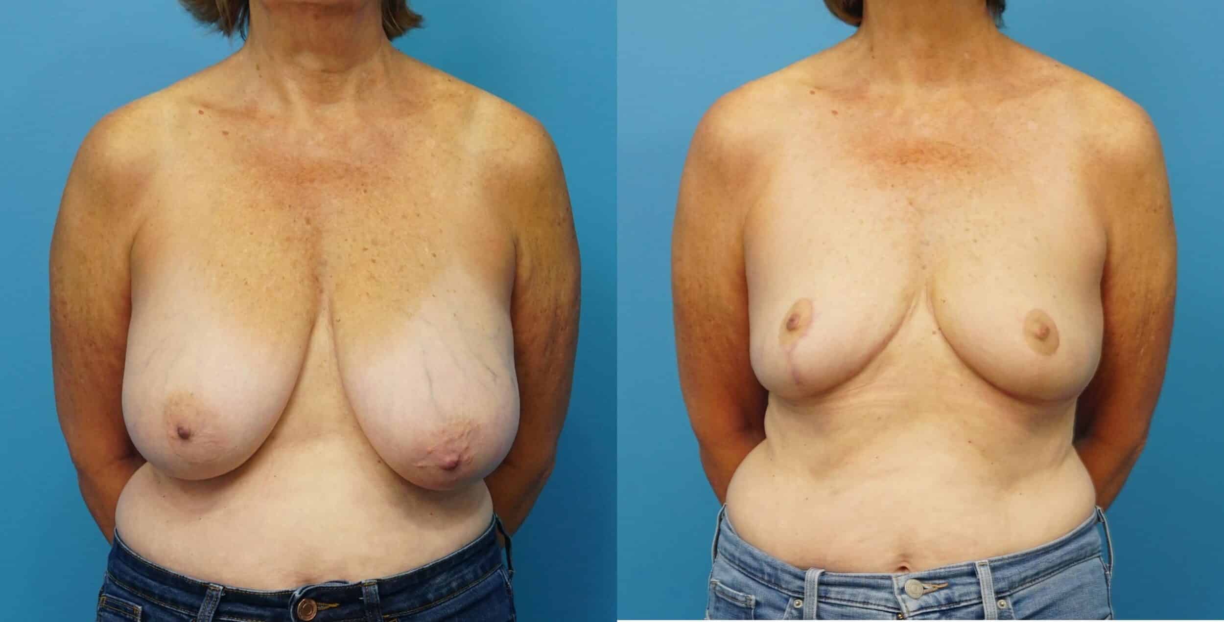 Before and After Image: Oncoplastic Breast Reduction and Lift