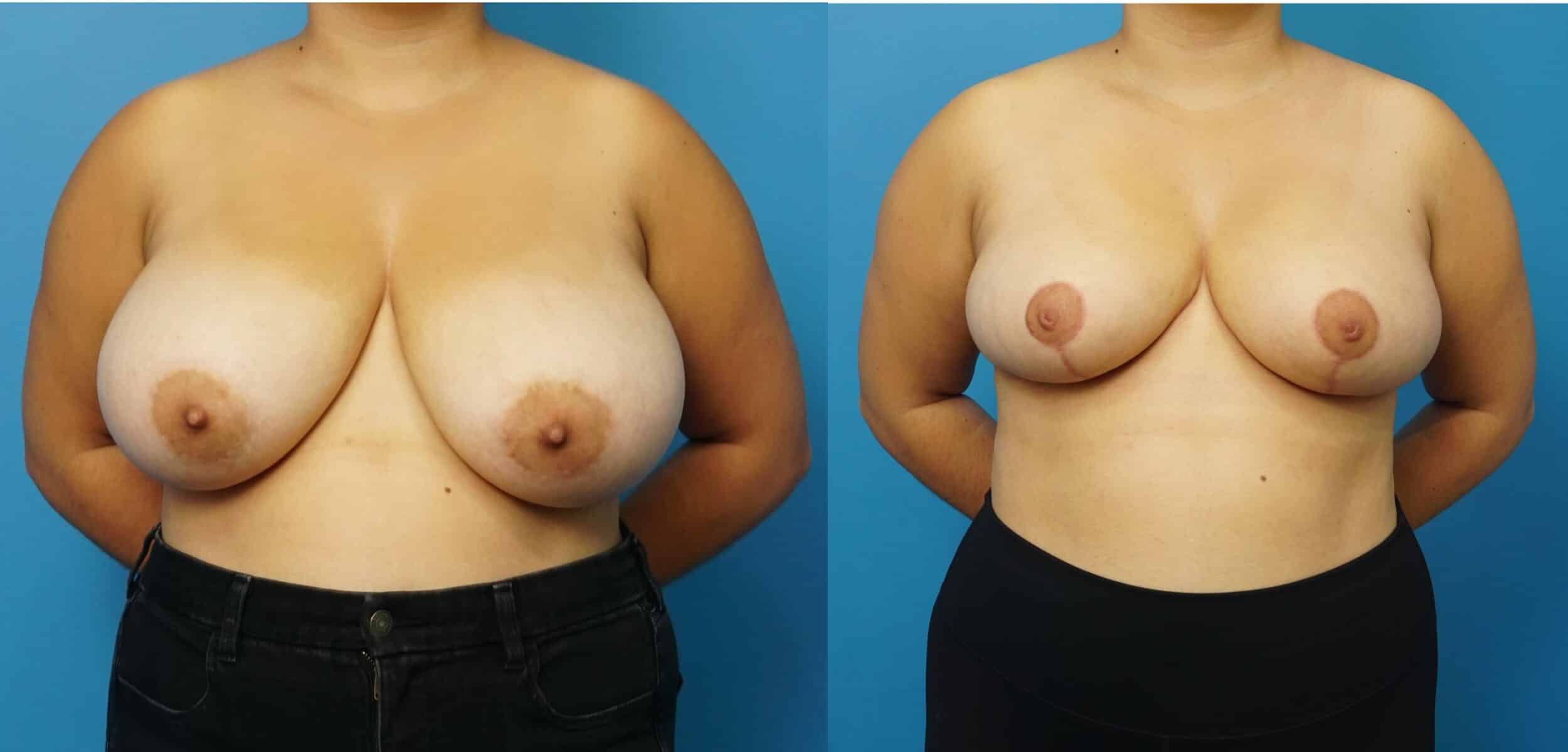 Before and After Image: Breast Reduction and Lift - front