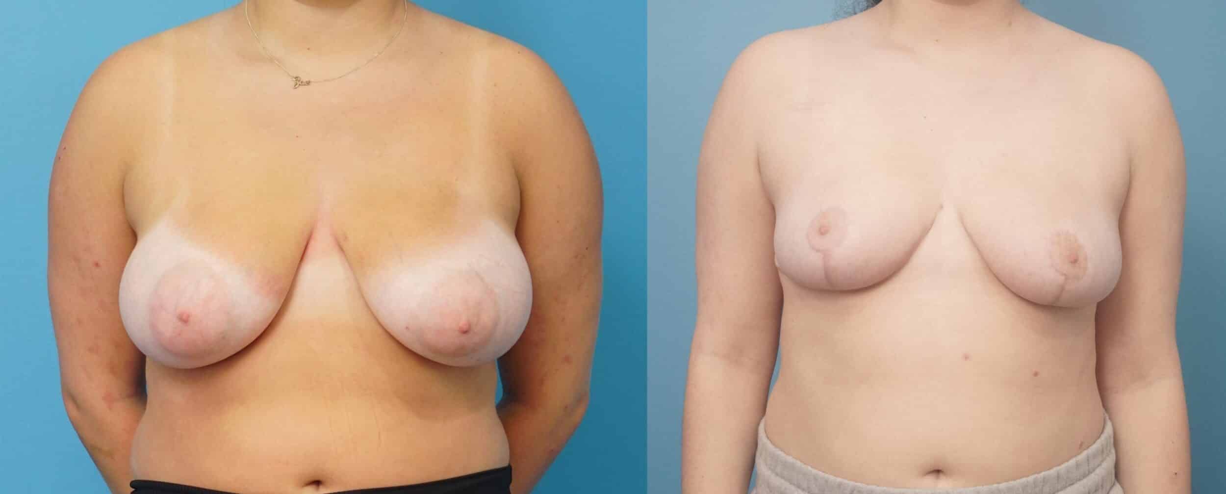 Before and After Image: Breast Reduction and Lift - front