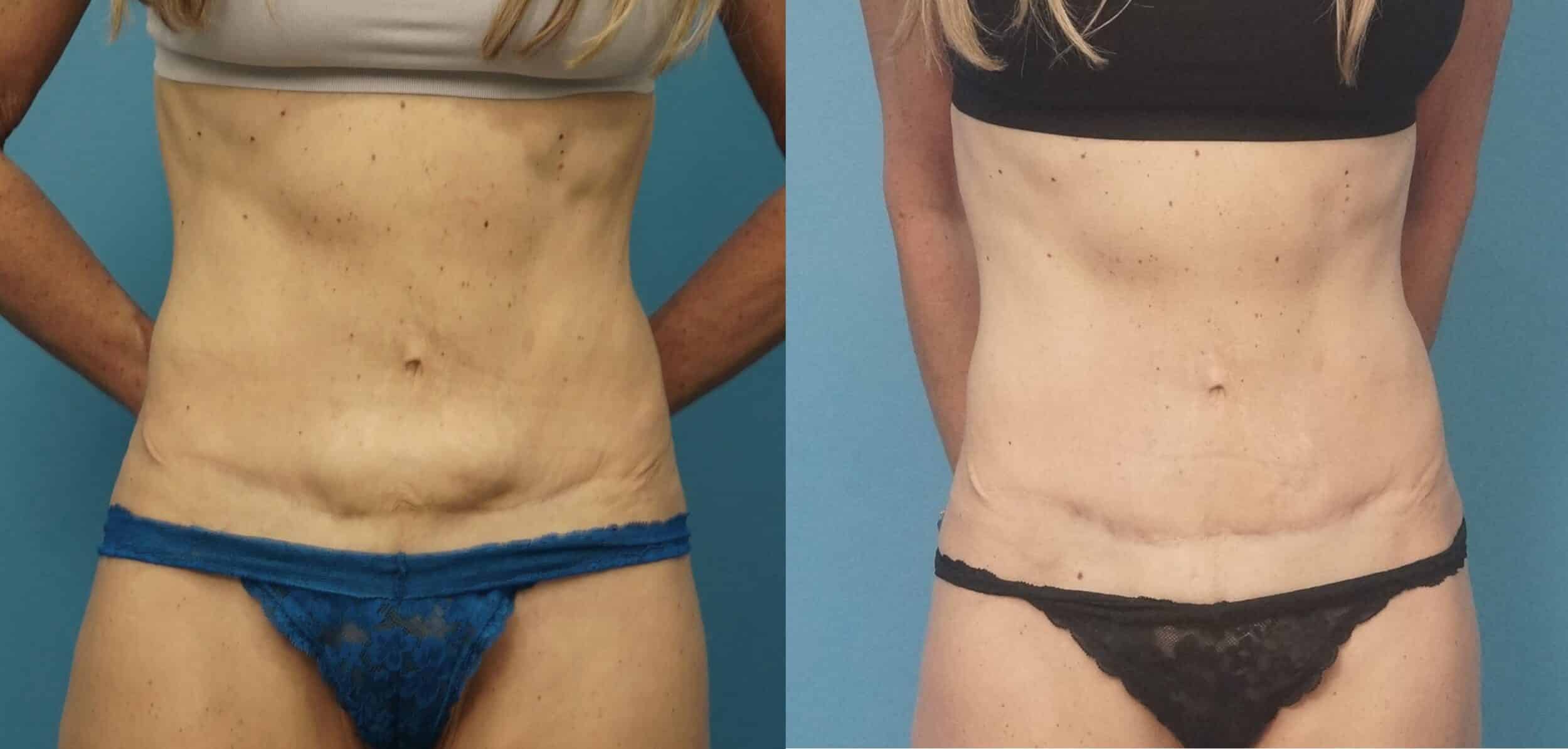 Before and After Image: Revision Abdominoplasty - front