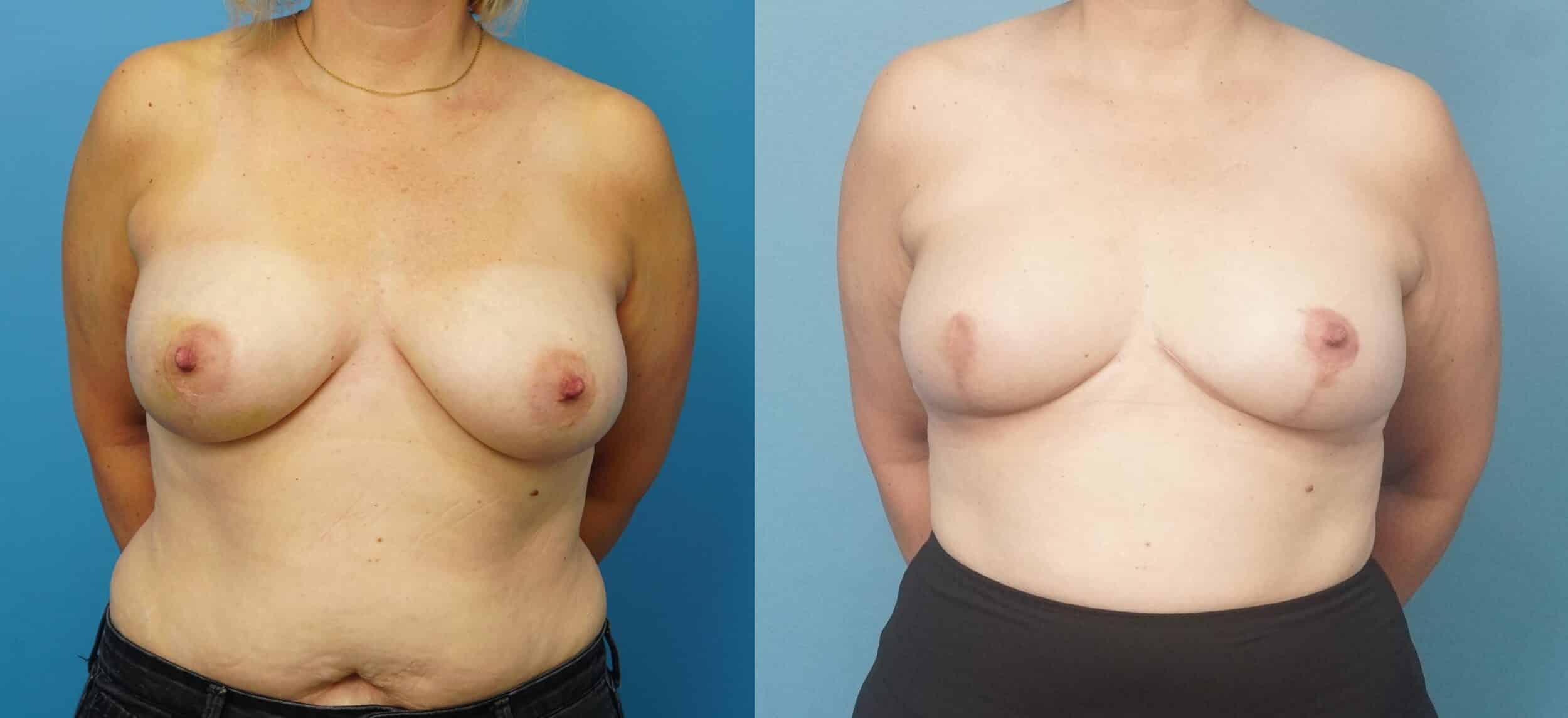 Before and After Image: Oncoplastic Breast Reduction-Central Lumpectomy - front