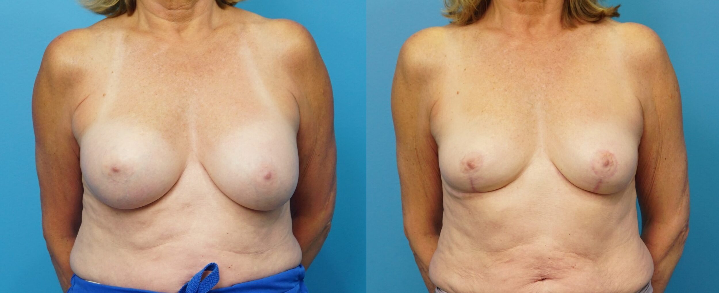 Before and After Image: Removal of Ruptured Implants with Lift