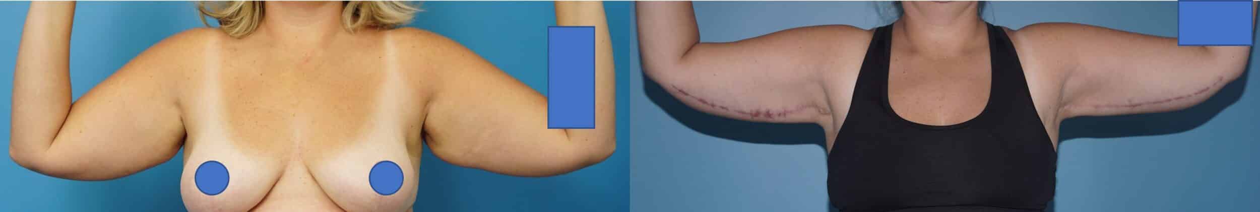 Before and After Image: Brachioplasty with Liposuction - front
