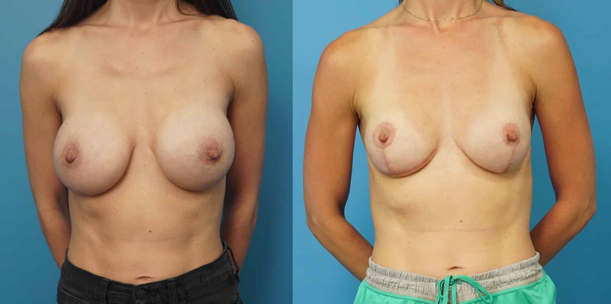 Before and After Image: Revision of Breast Reconstruction