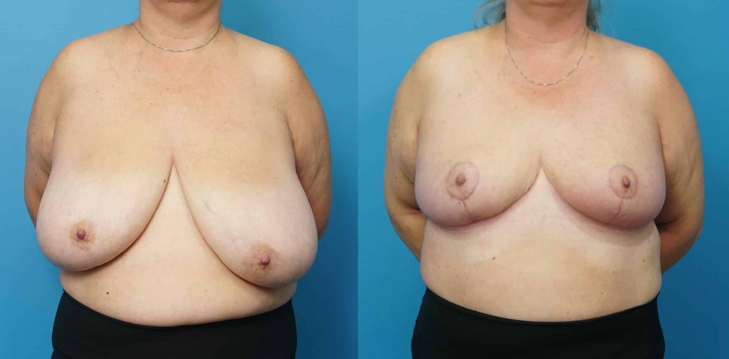 Before and After Image: Breast Reduction and Lift - front