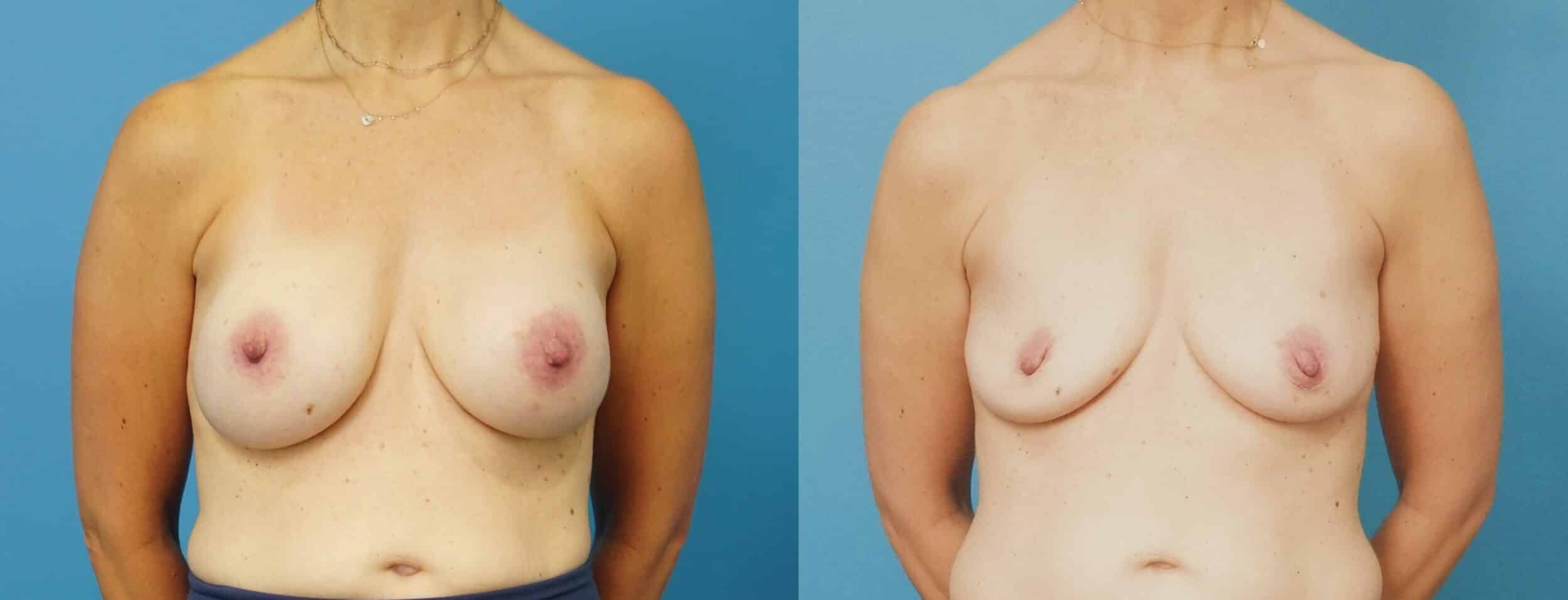 Before and After Image: Wide Awake Breast Implant Removal