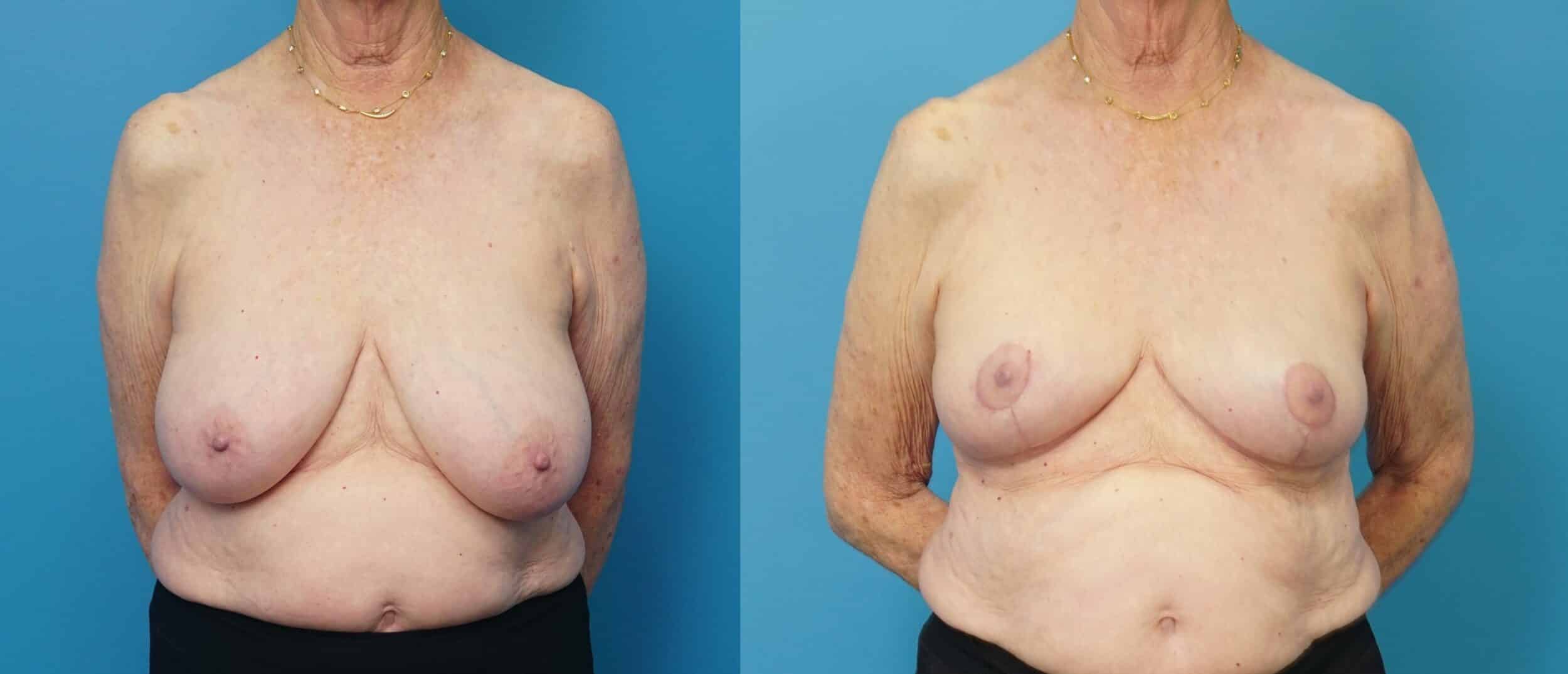 Before and After Image: Breast Reduction and Lift - front