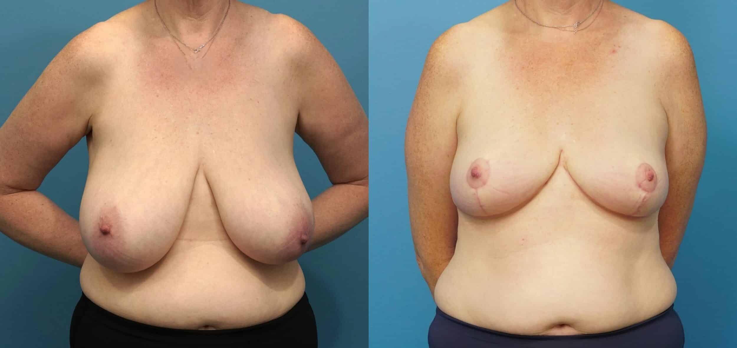 Before and After Image: Breast Reduction and Lift