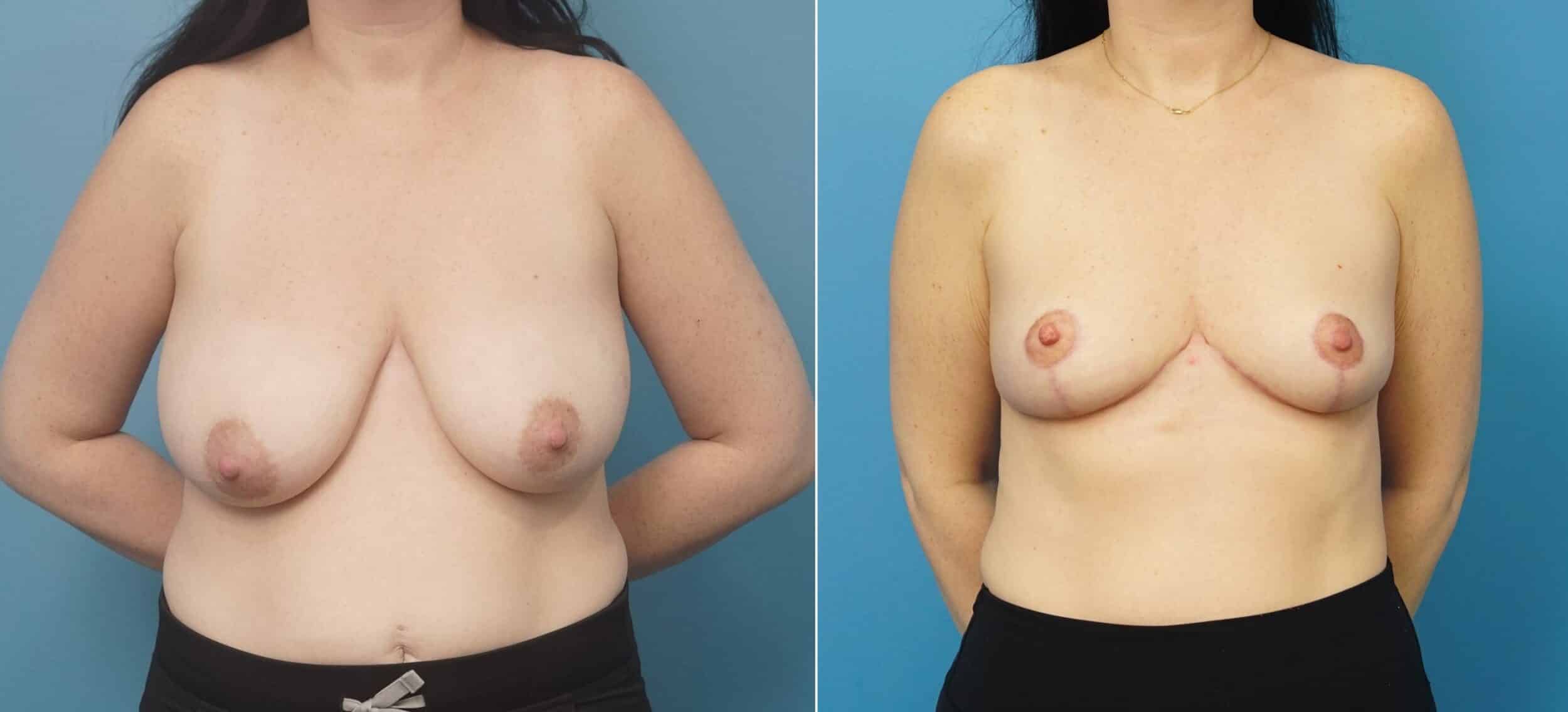 Before and After Image: Breast Reduction and Lift