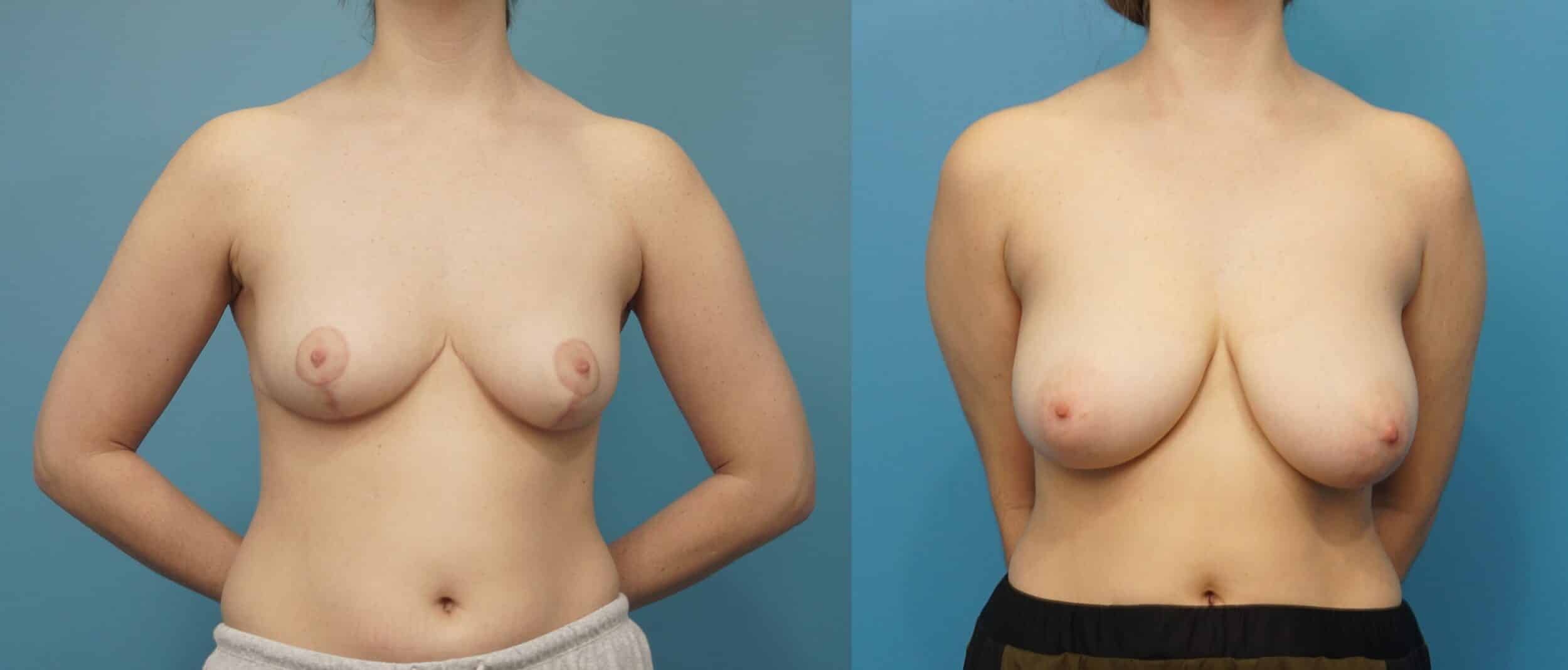 Before and After Image: Breast Reduction and Lift - front