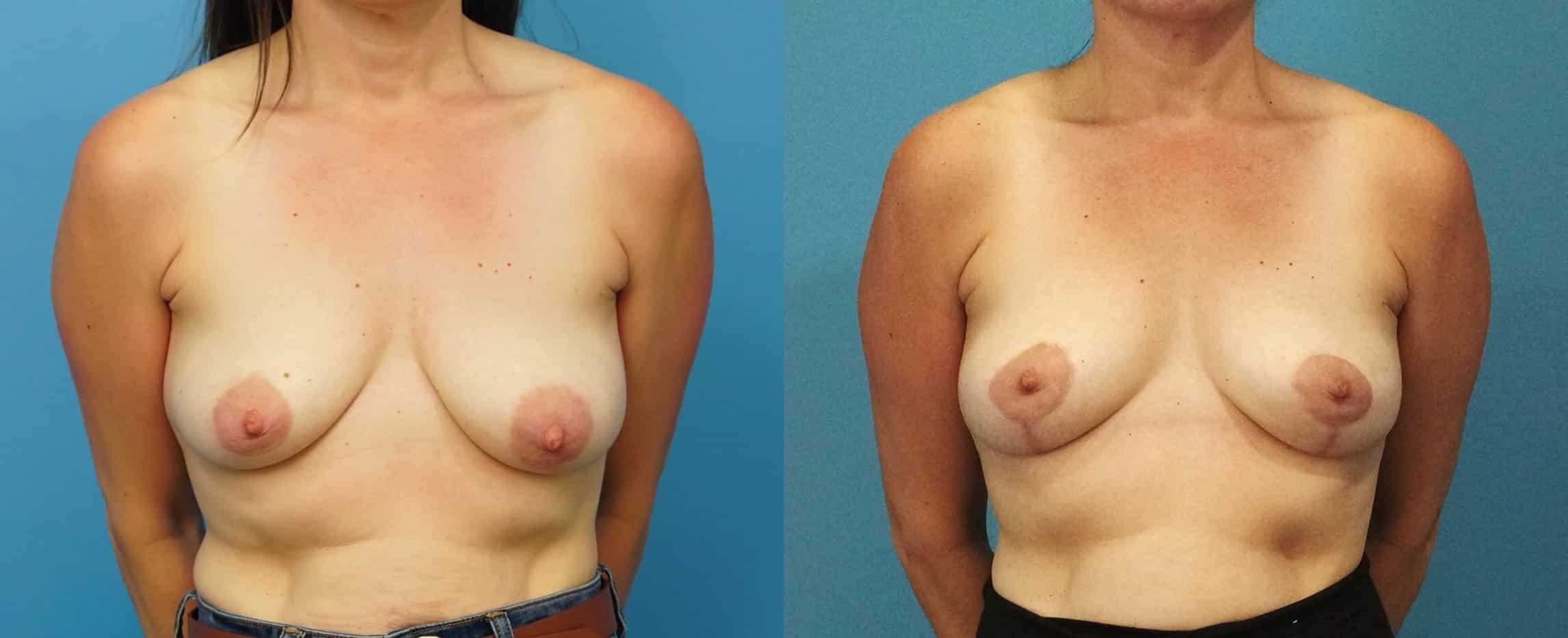 Before and After Image: Oncoplastic Breast Lift - front