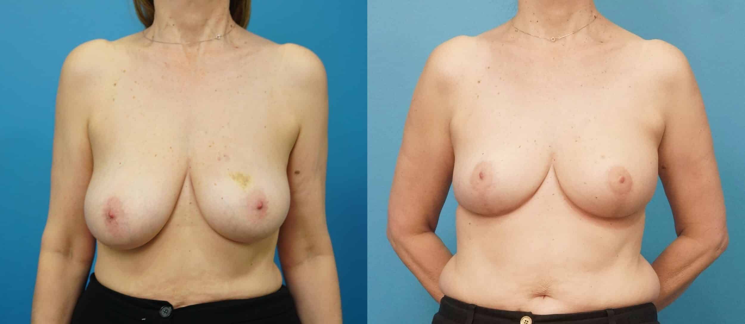 Before and After Image: Oncoplastic Breast Reduction and Lift - front