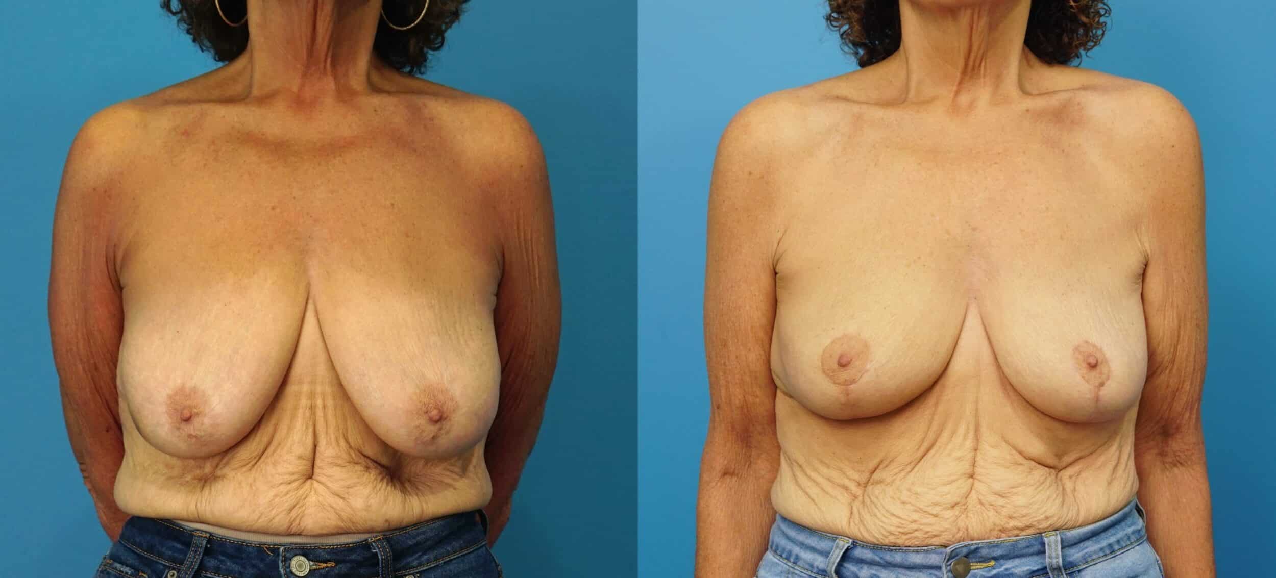 Before and After Image: Oncoplastic Breast Lift