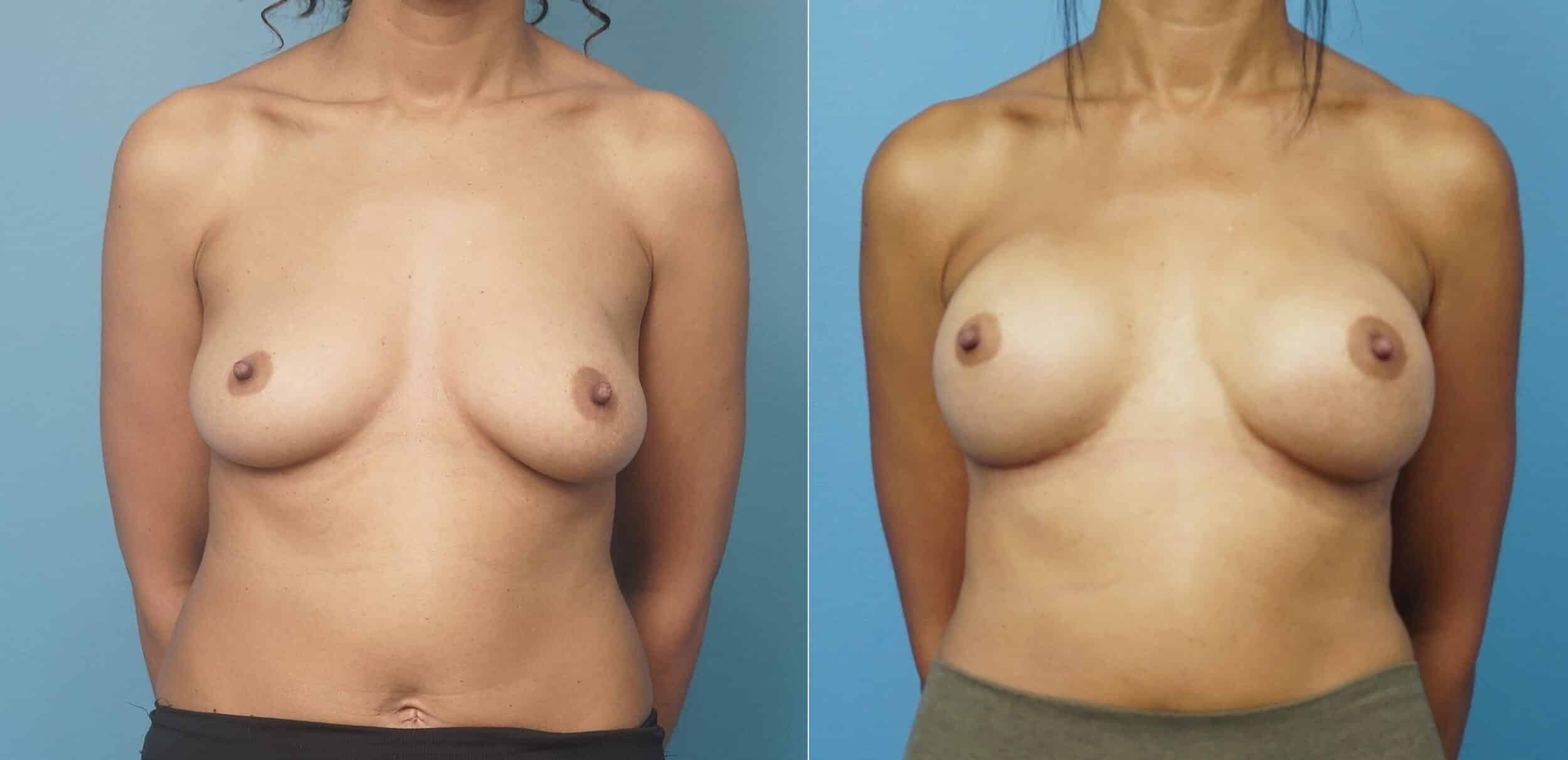 Before and After Image: Breast Reconstruction with Tissue Expanders - front