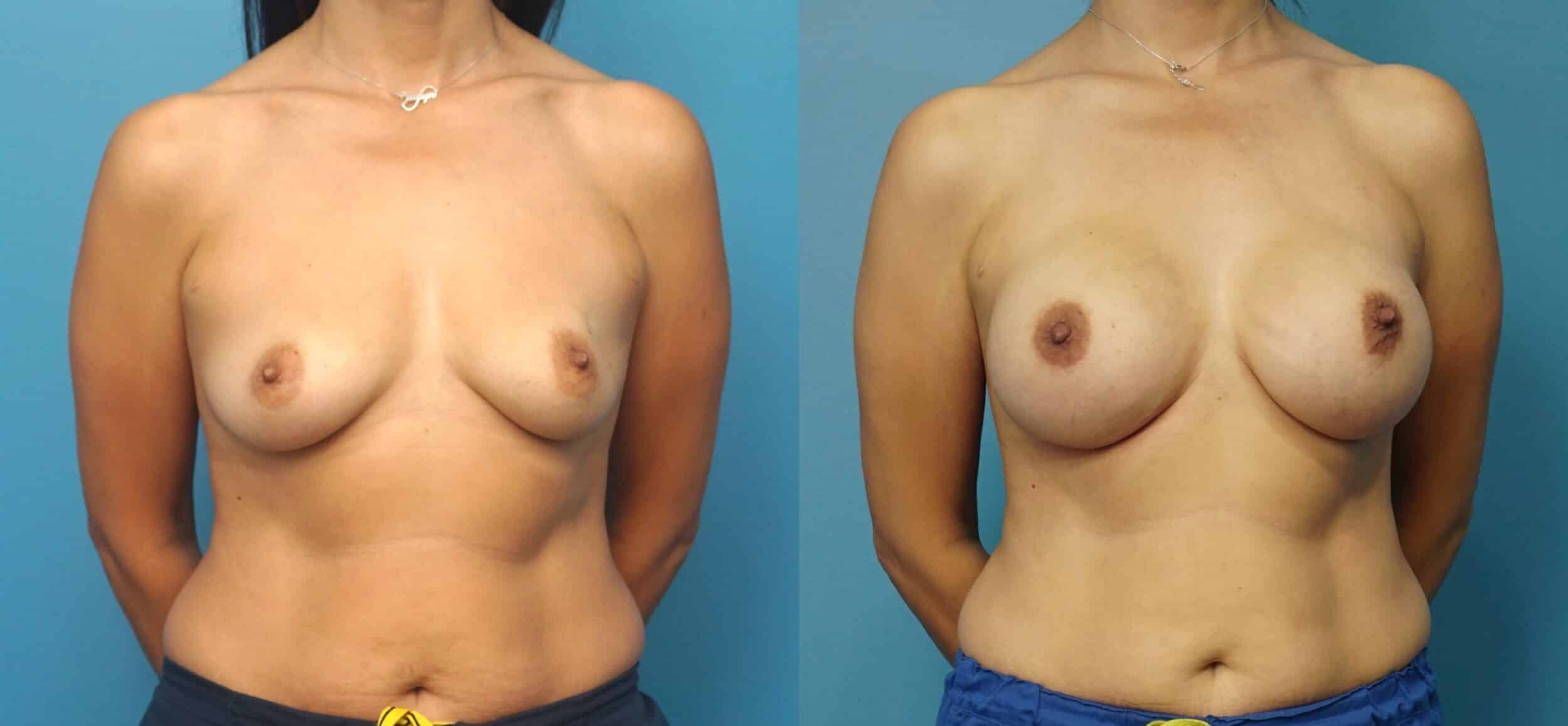 Before and After Image: Breast Reconstruction with Tissue Expanders - front