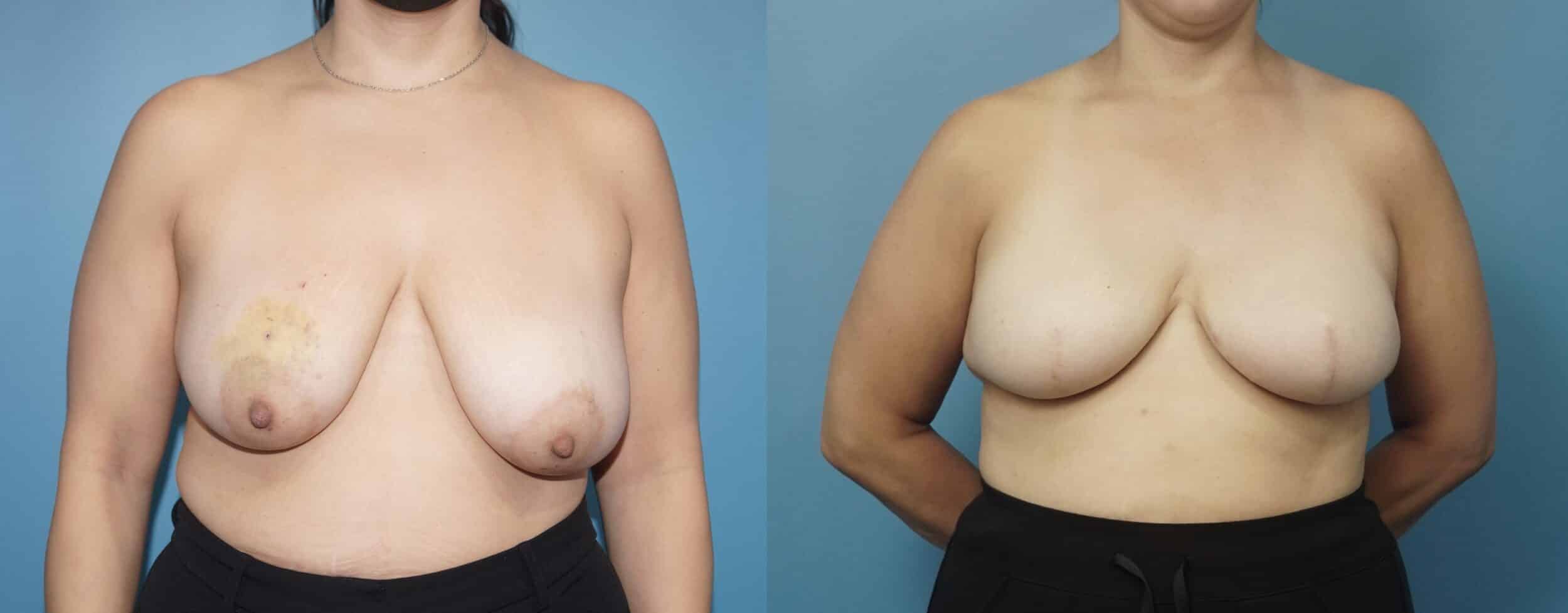 Before and After Image: Breast Reconstruction with Tissue Expanders - front