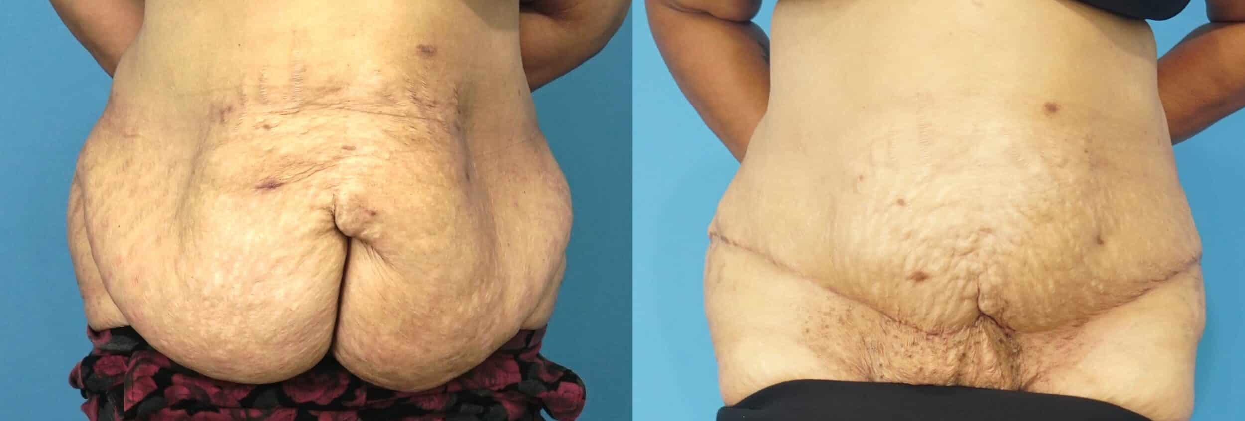 Before and After Image: Reconstructive Panniculectomy - front