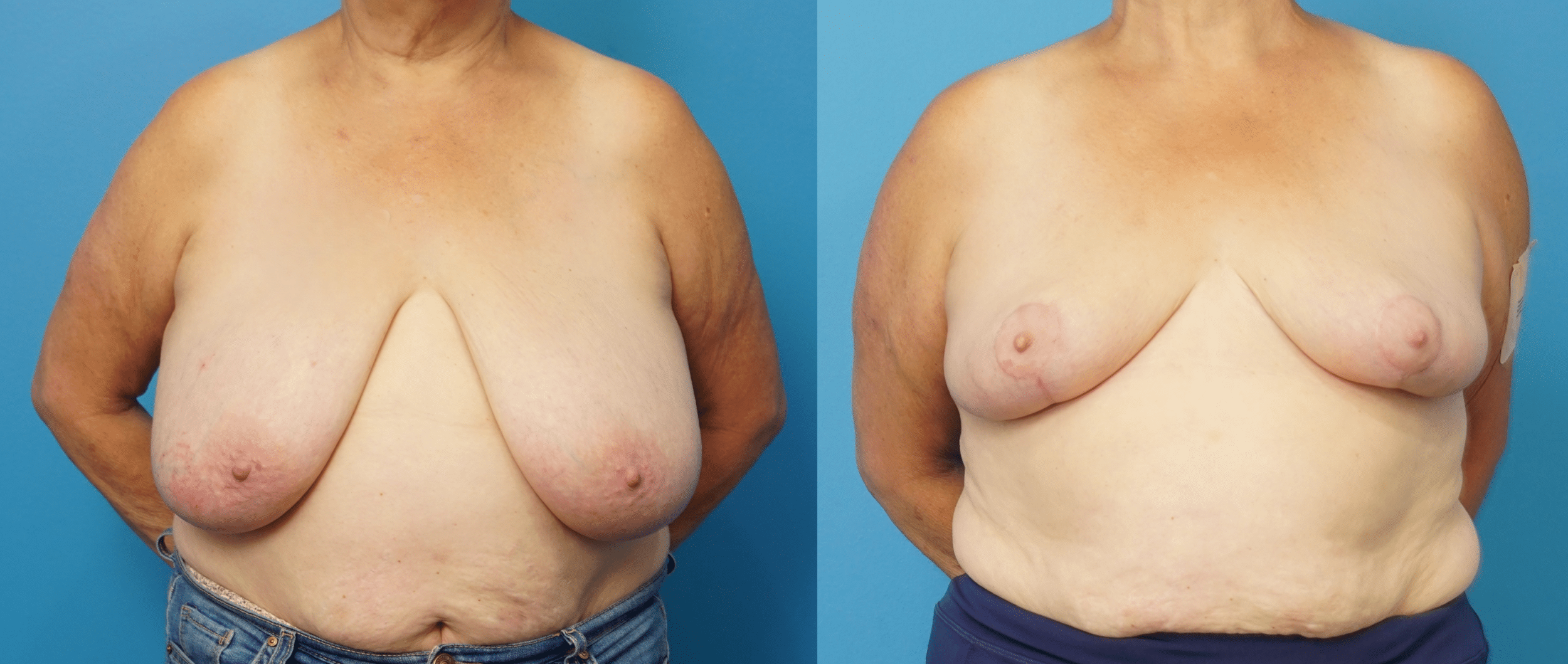Before and After Image: Breast Reduction and Lift - front
