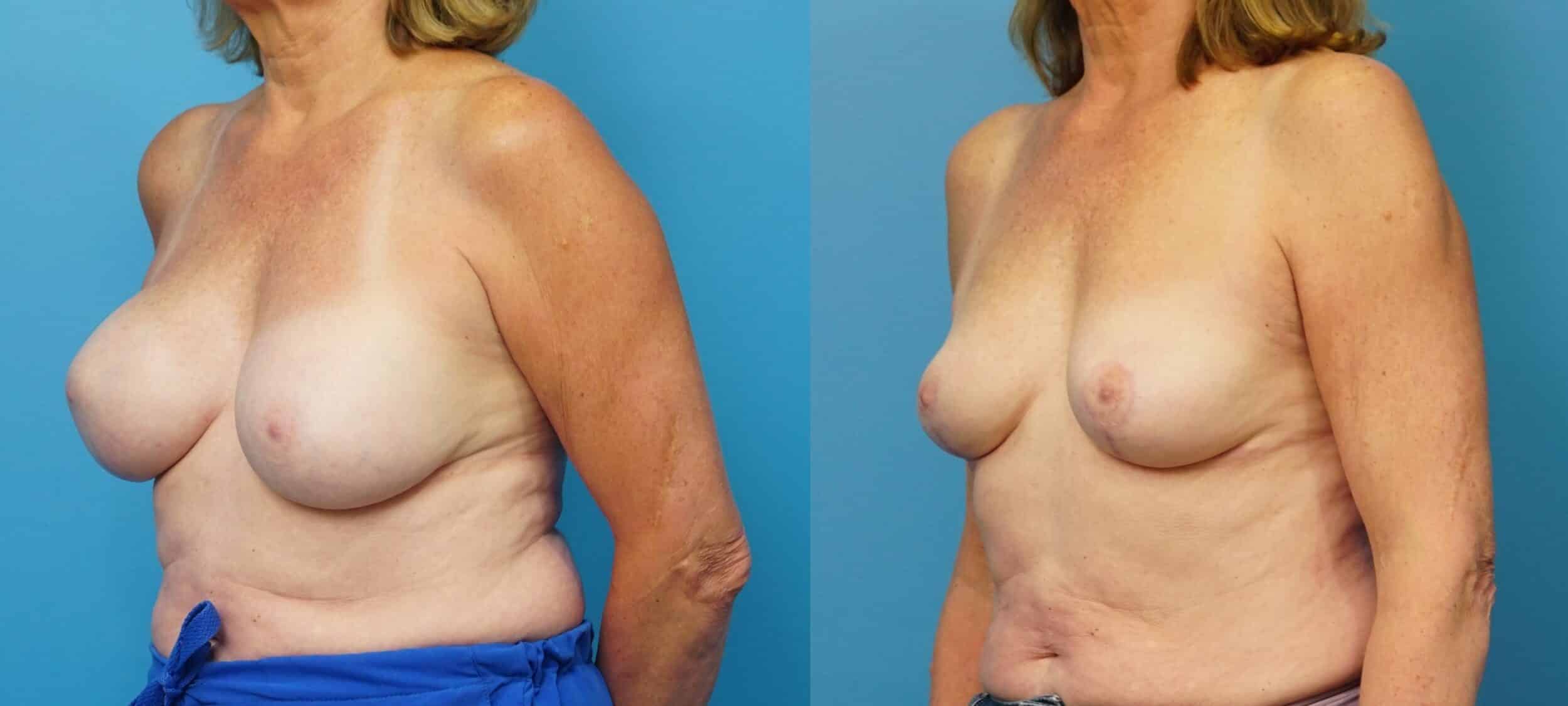 Before and After Image: Removal of Ruptured Implants with Lift - left-front-oblique