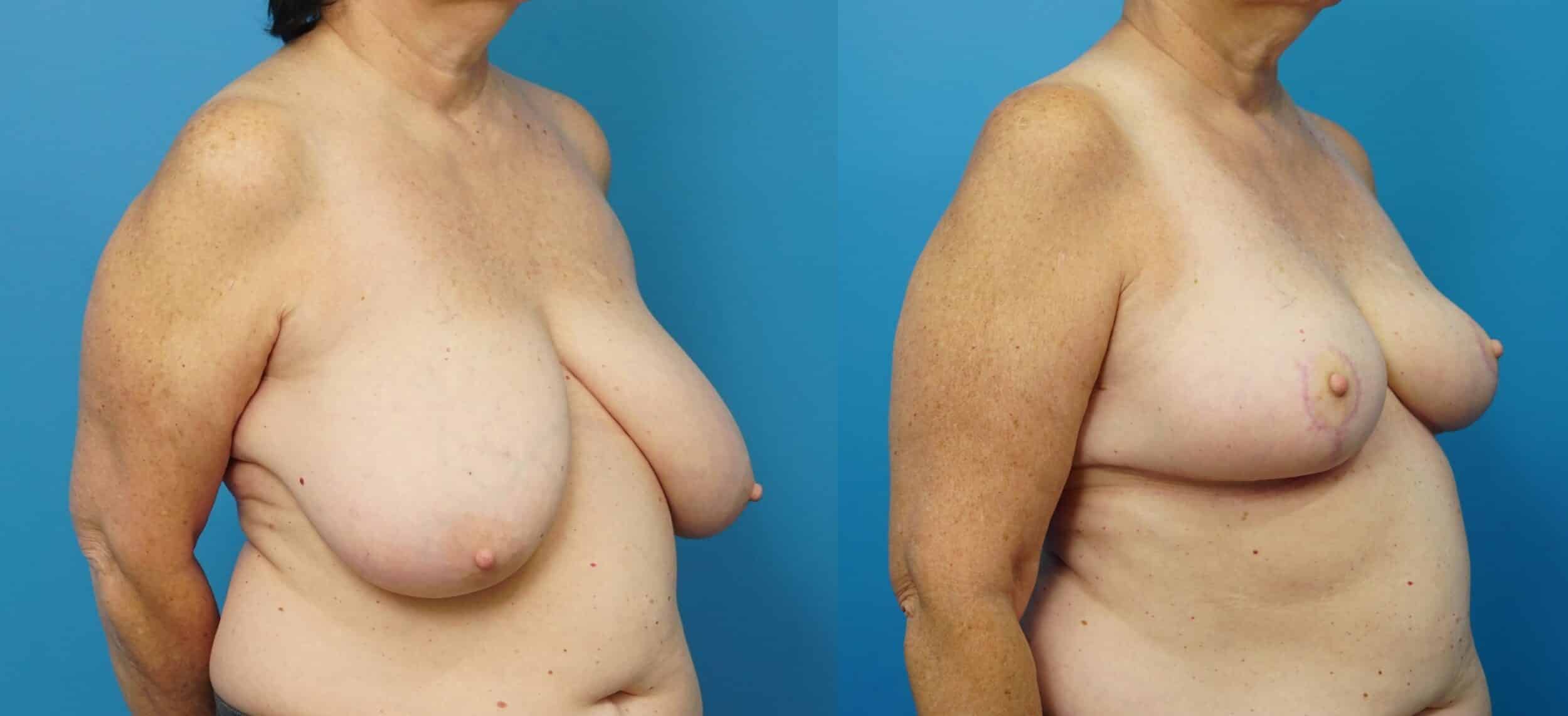 Before and After Image: Breast Reduction and Lift - right-front-oblique