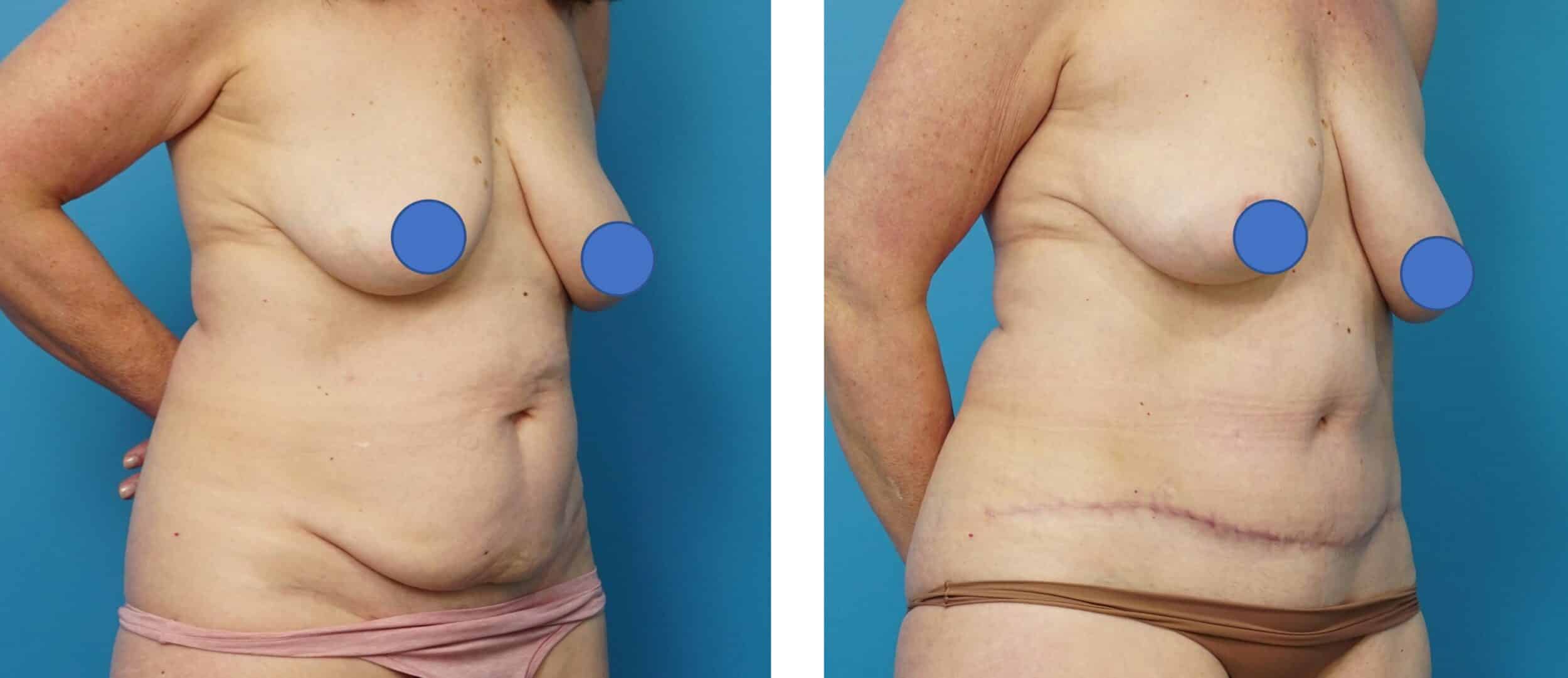 Before and After Image: Abdominoplasty with Flank Liposuction -