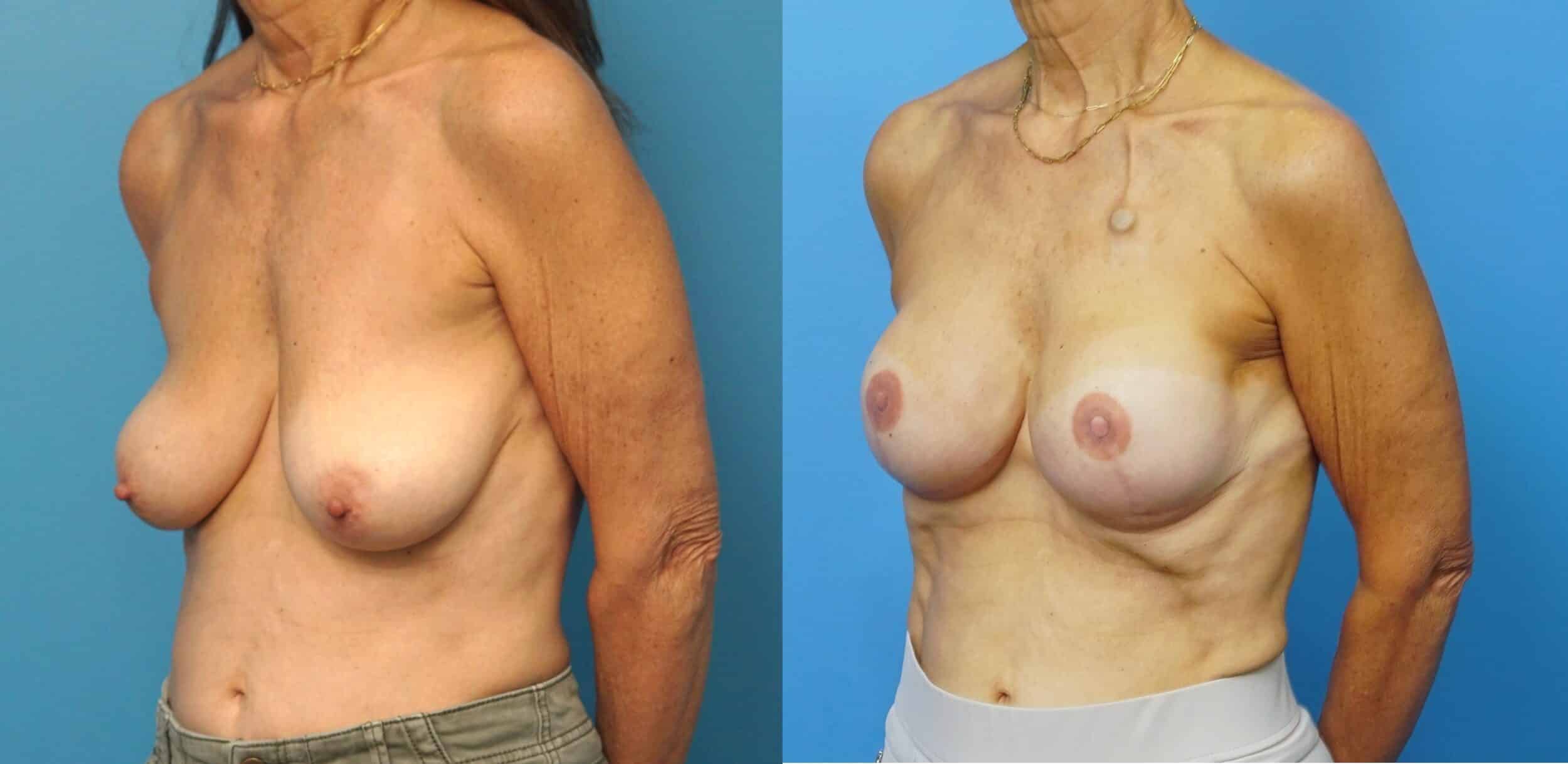 Before and After Image: Breast Reconstruction with Tissue Expanders - left-front-oblique