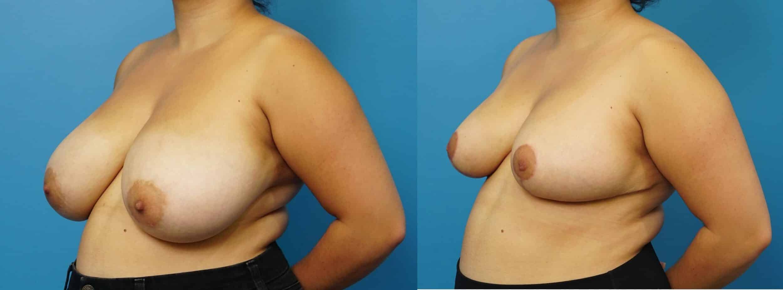 Before and After Image: Breast Reduction and Lift - left-front-oblique