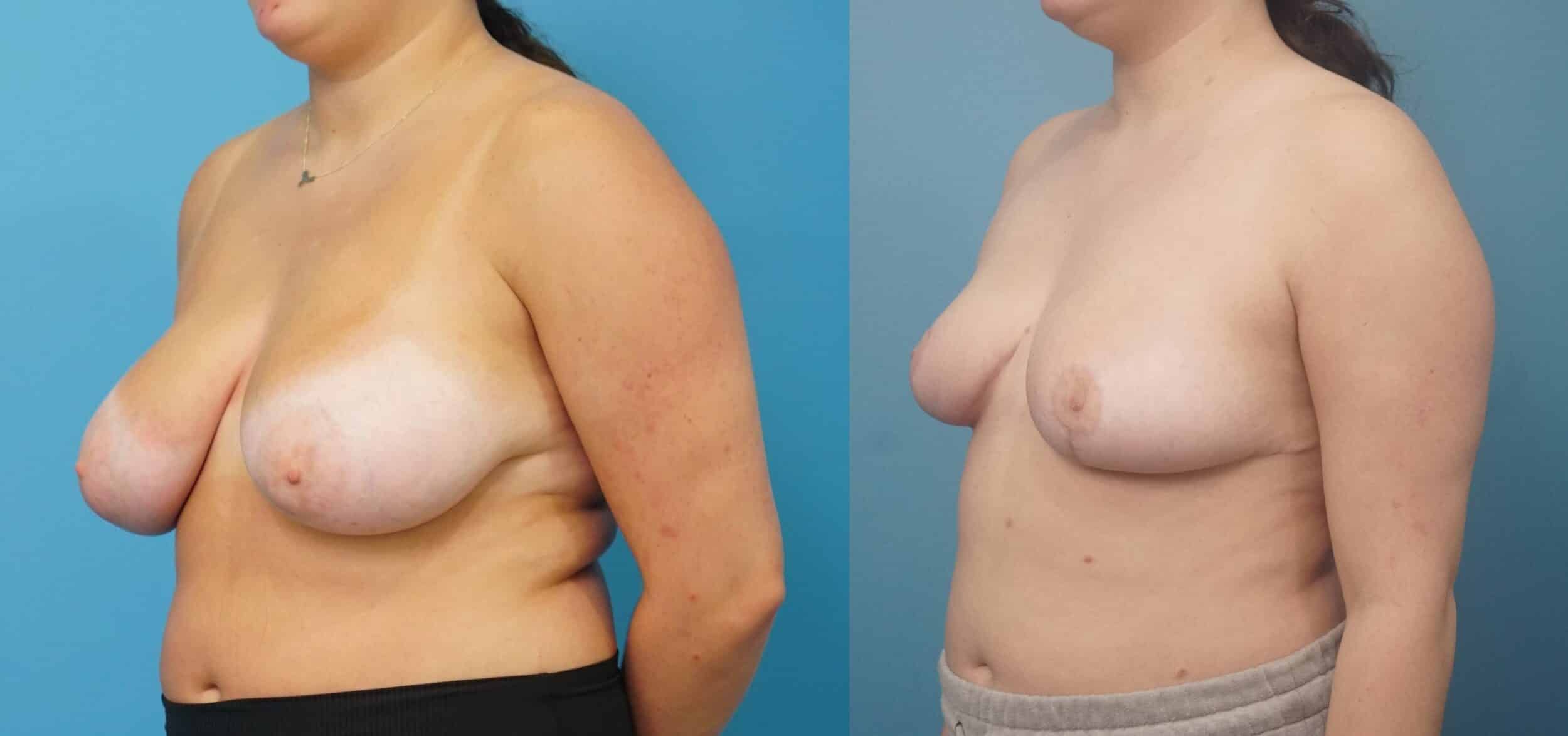 Before and After Image: Breast Reduction and Lift - left-front-oblique