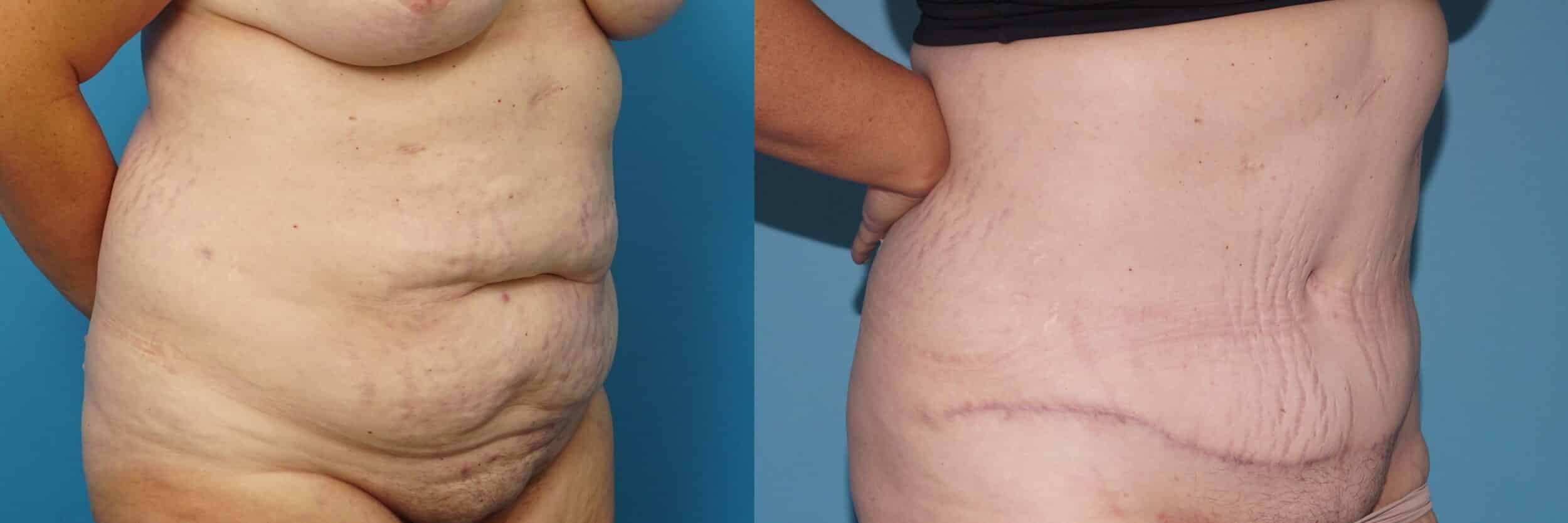 Before and After Image: Abdominoplasty with Flank Liposuction