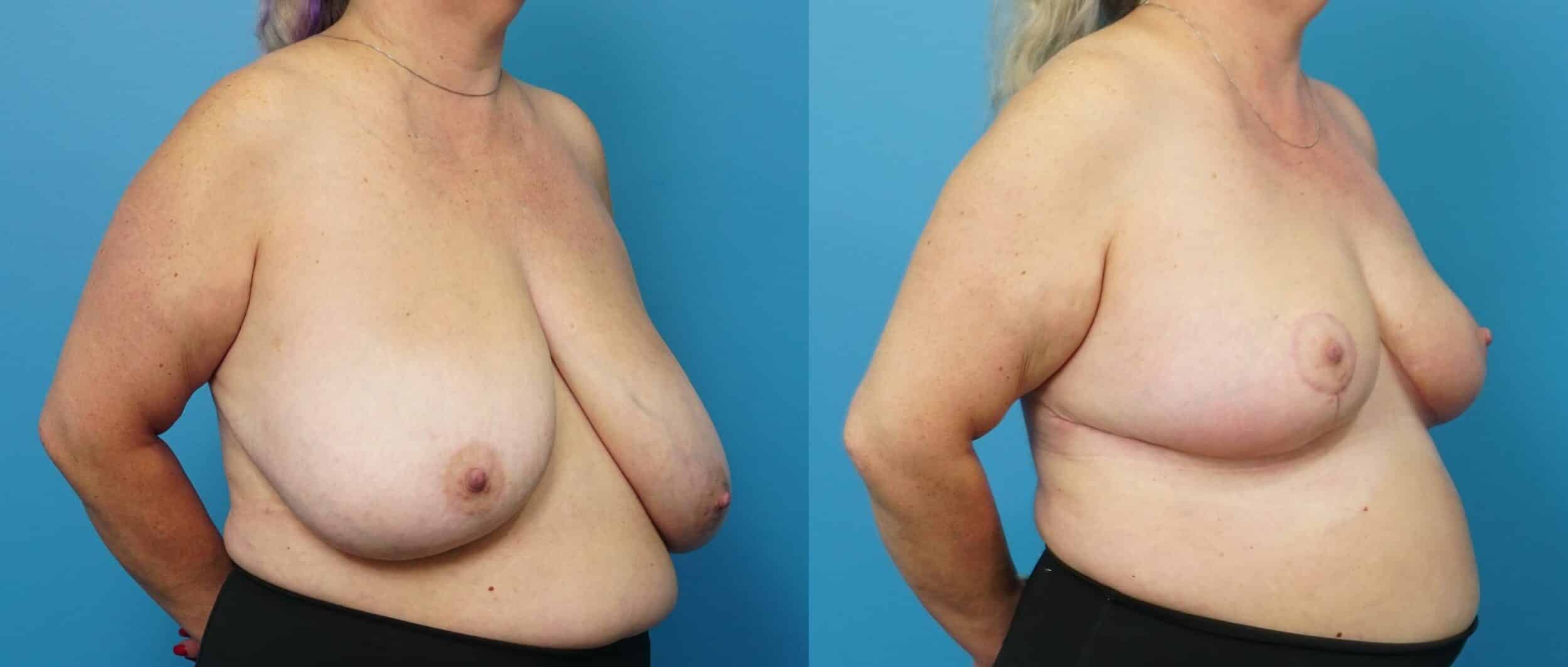 Before and After Image: Breast Reduction and Lift - right-front-oblique