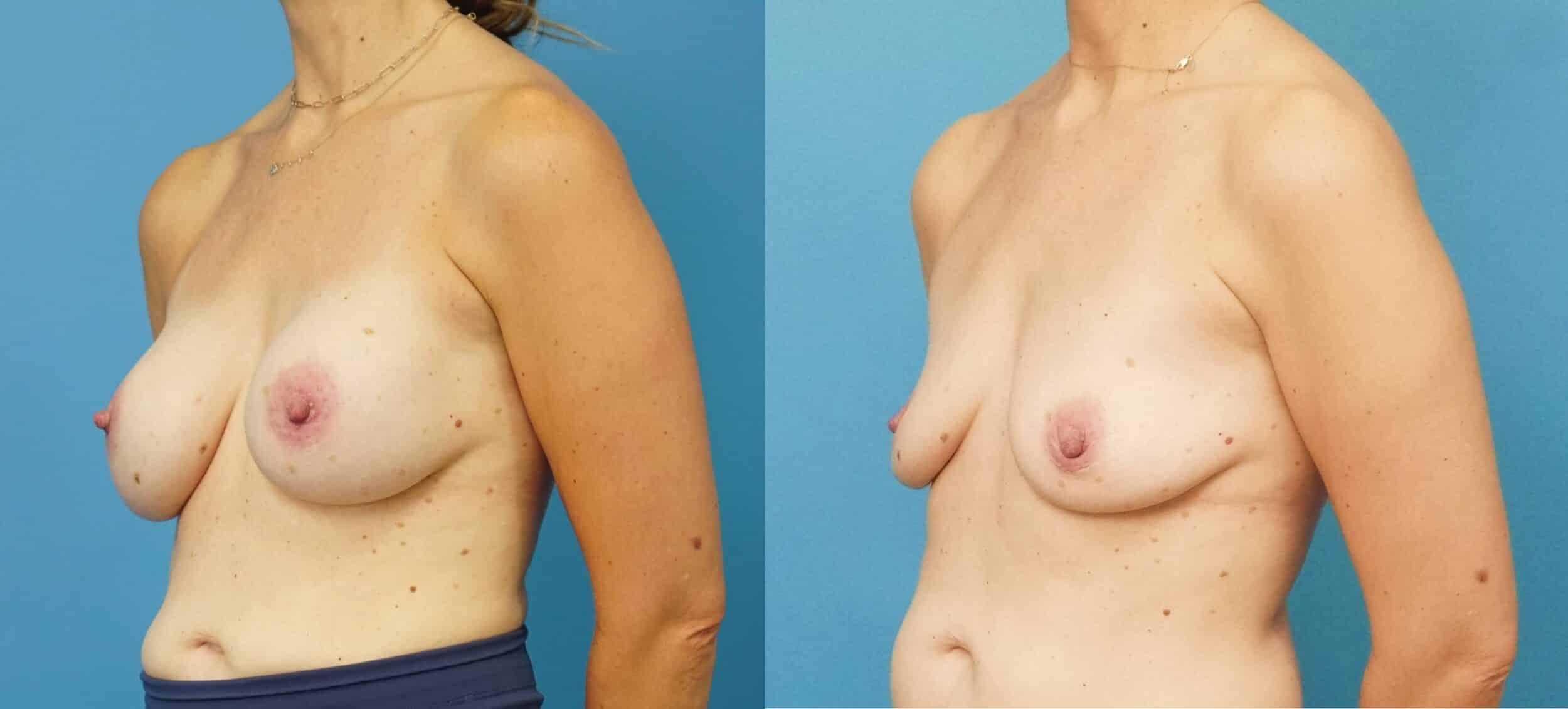 Before and After Image: Wide Awake Breast Implant Removal - left-front-oblique