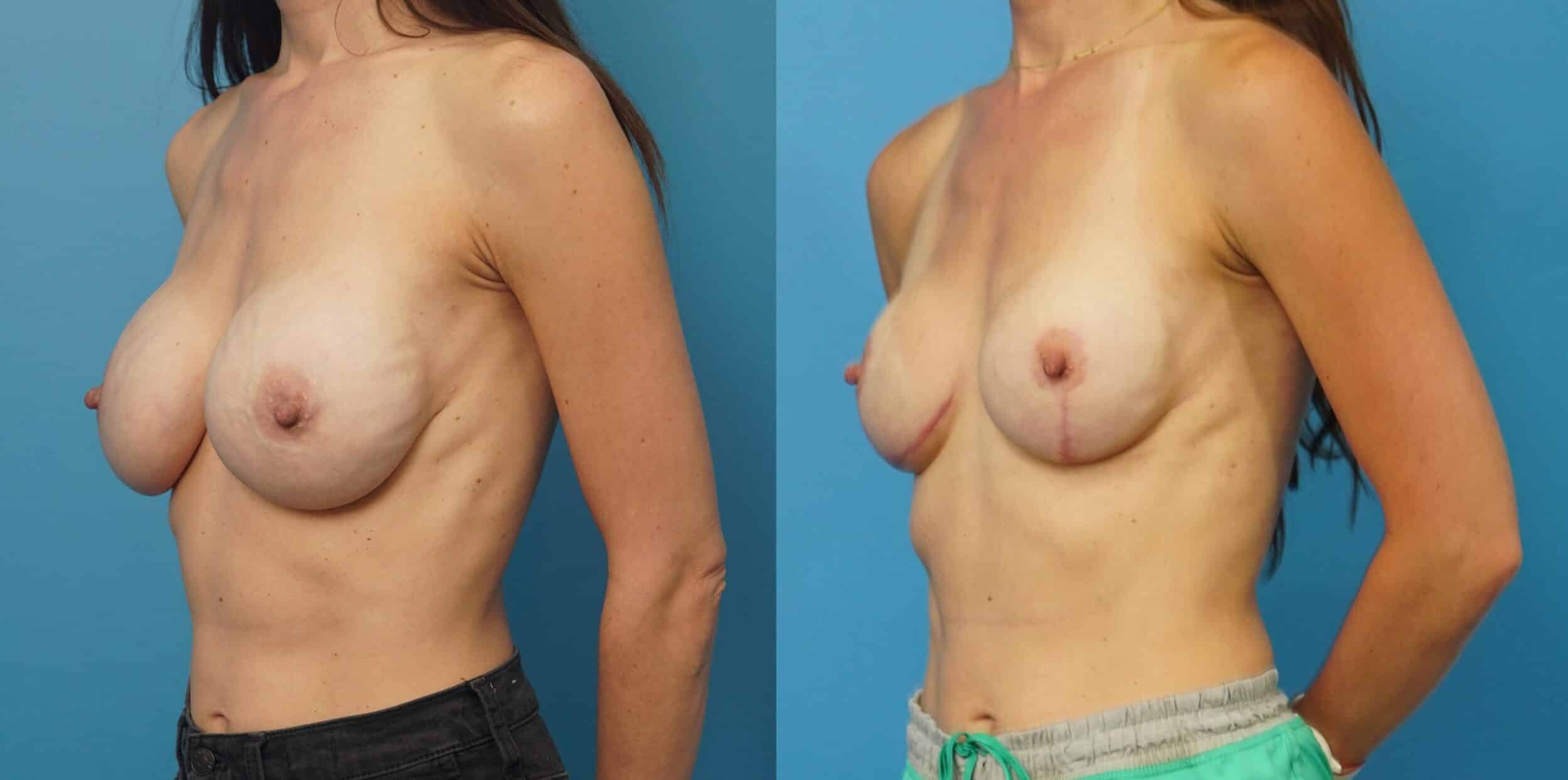Before and After Image: Revision of Breast Reconstruction - left-front-oblique
