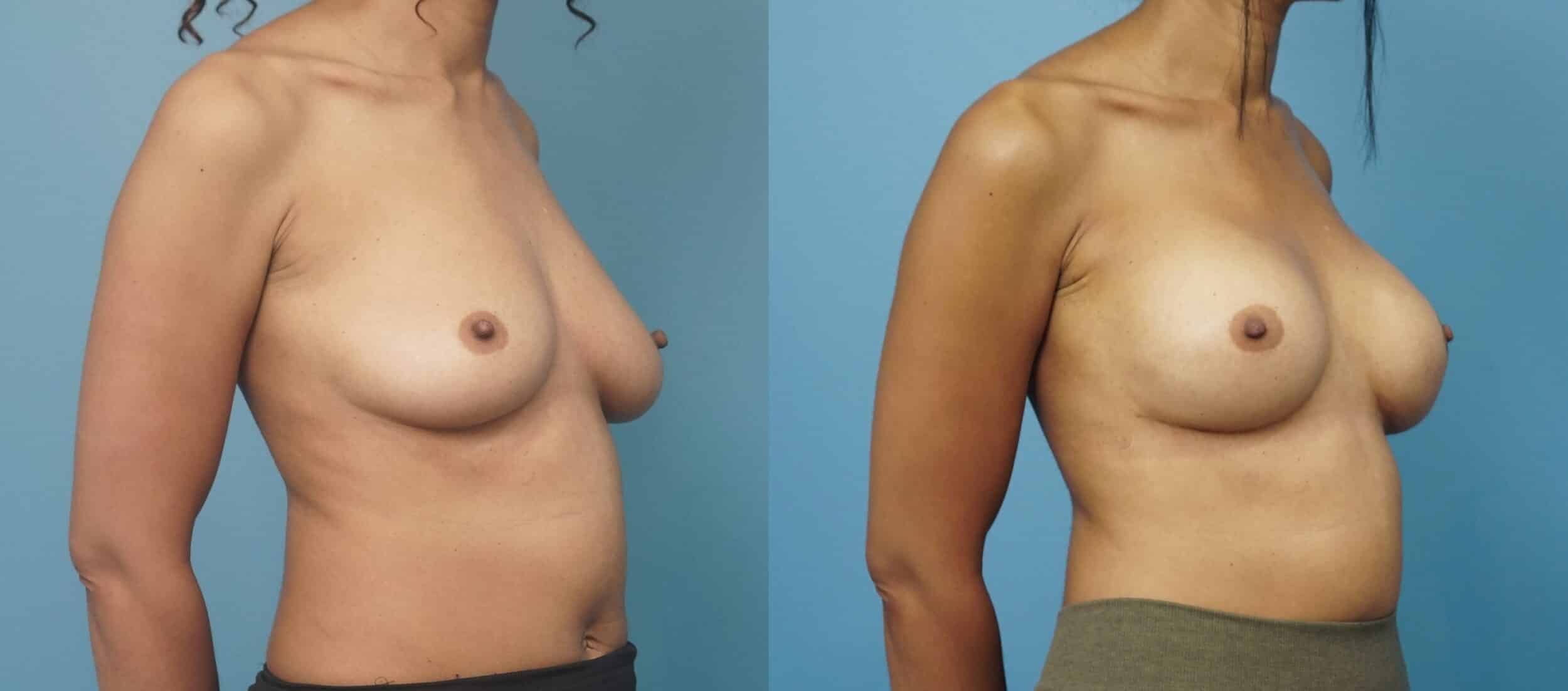 Before and After Image: Breast Reconstruction with Tissue Expanders - right-front-oblique