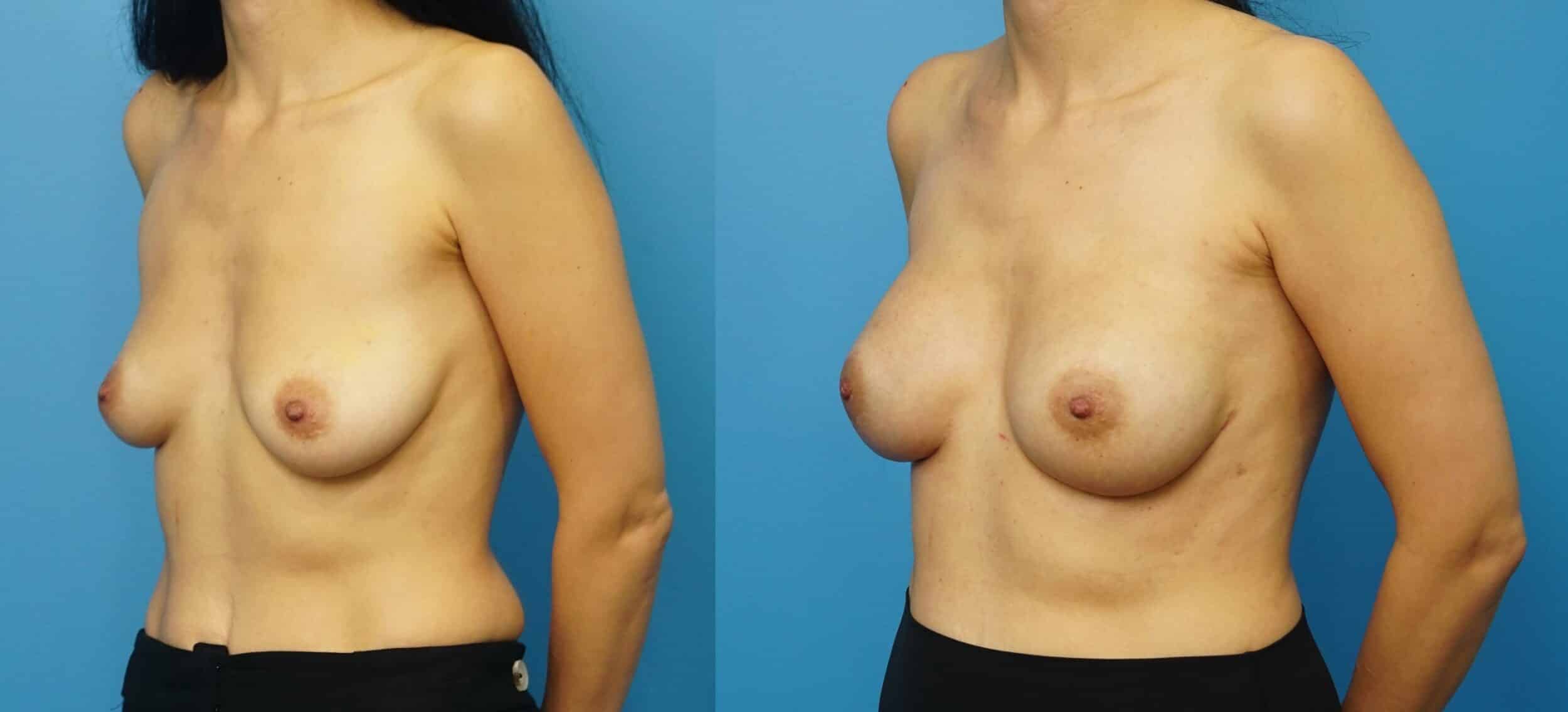 Before and After Image: Breast Reconstruction with Retropectoral Tissue Expander - left-front-oblique