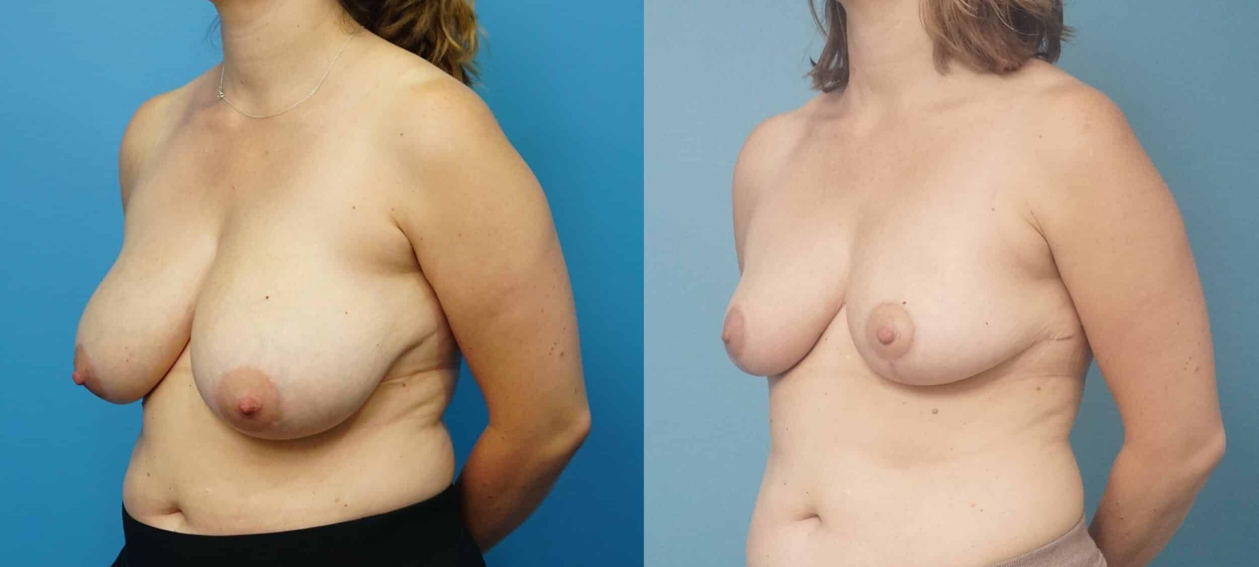 Before and After Image: Breast Reduction and Lift - left-front-oblique