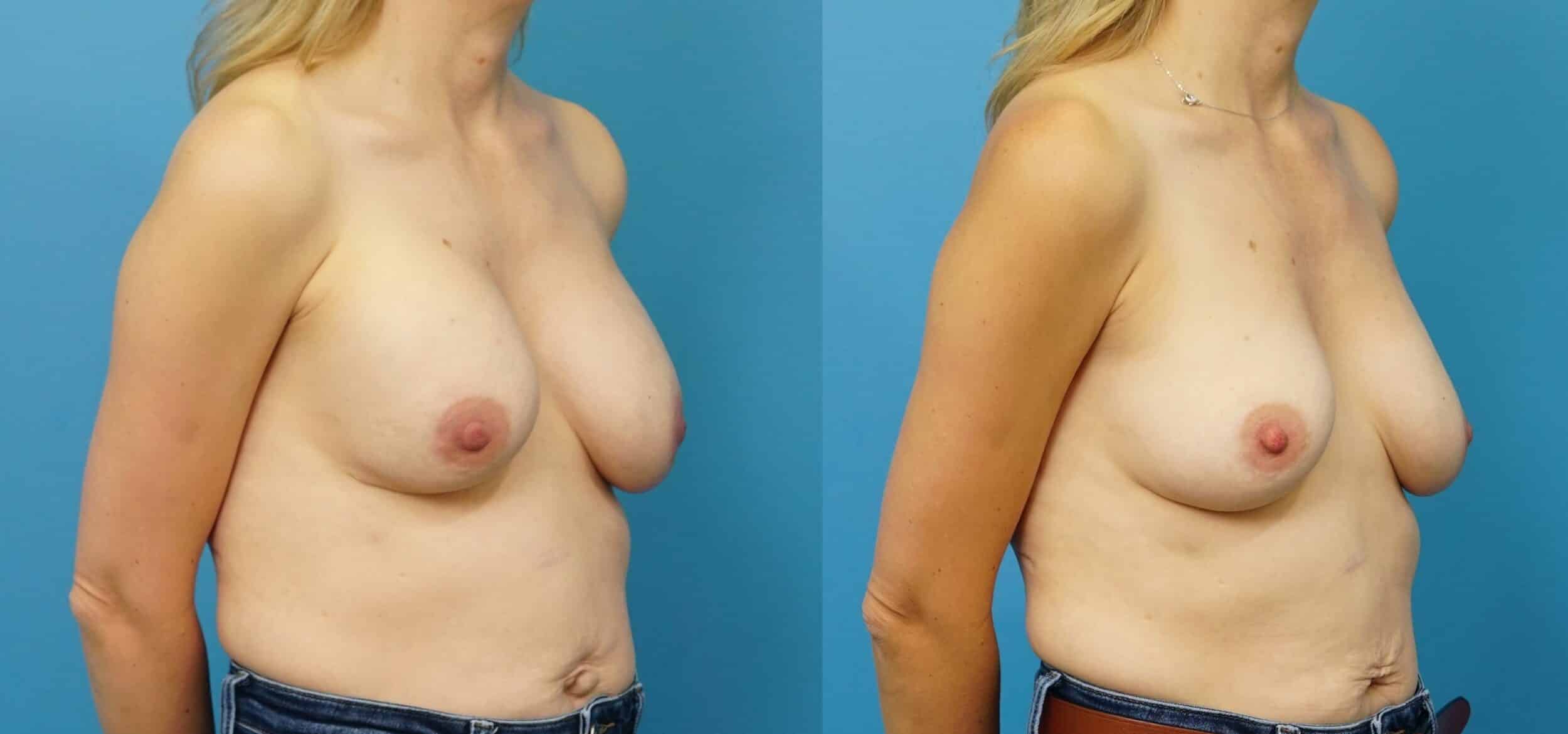 Before and After Image: Breast Implant Exchange and Downsizing - right-front-oblique