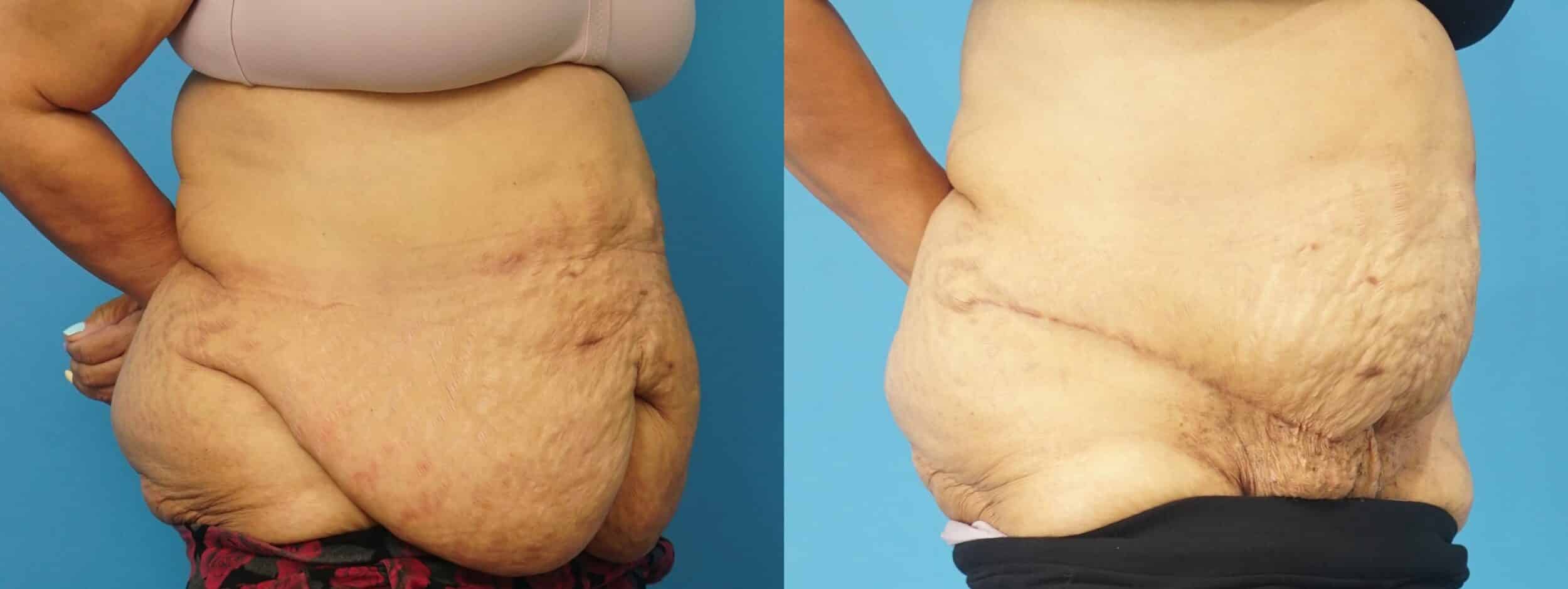 Before and After Image: Reconstructive Panniculectomy - right-front-oblique