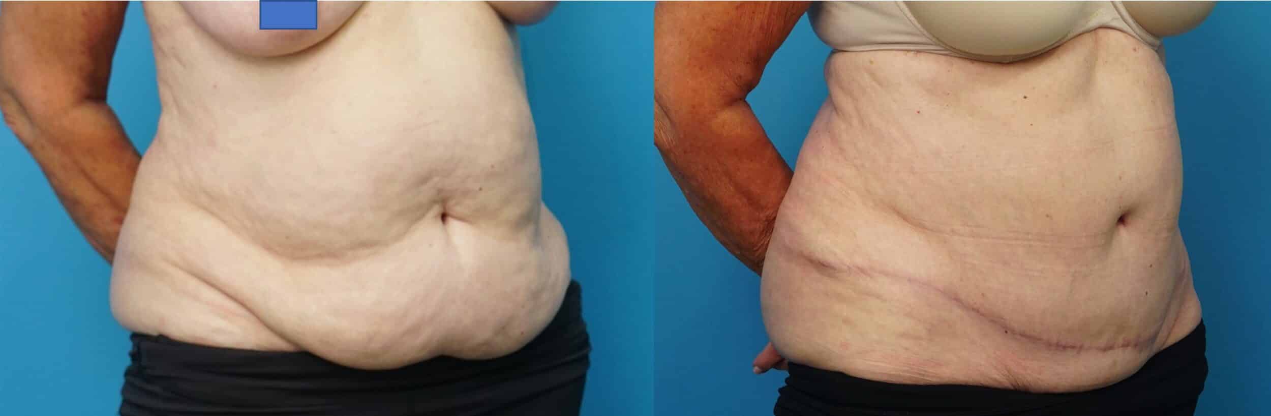 Before and After Image: Skin-Only Abdominoplasty with Liposuction