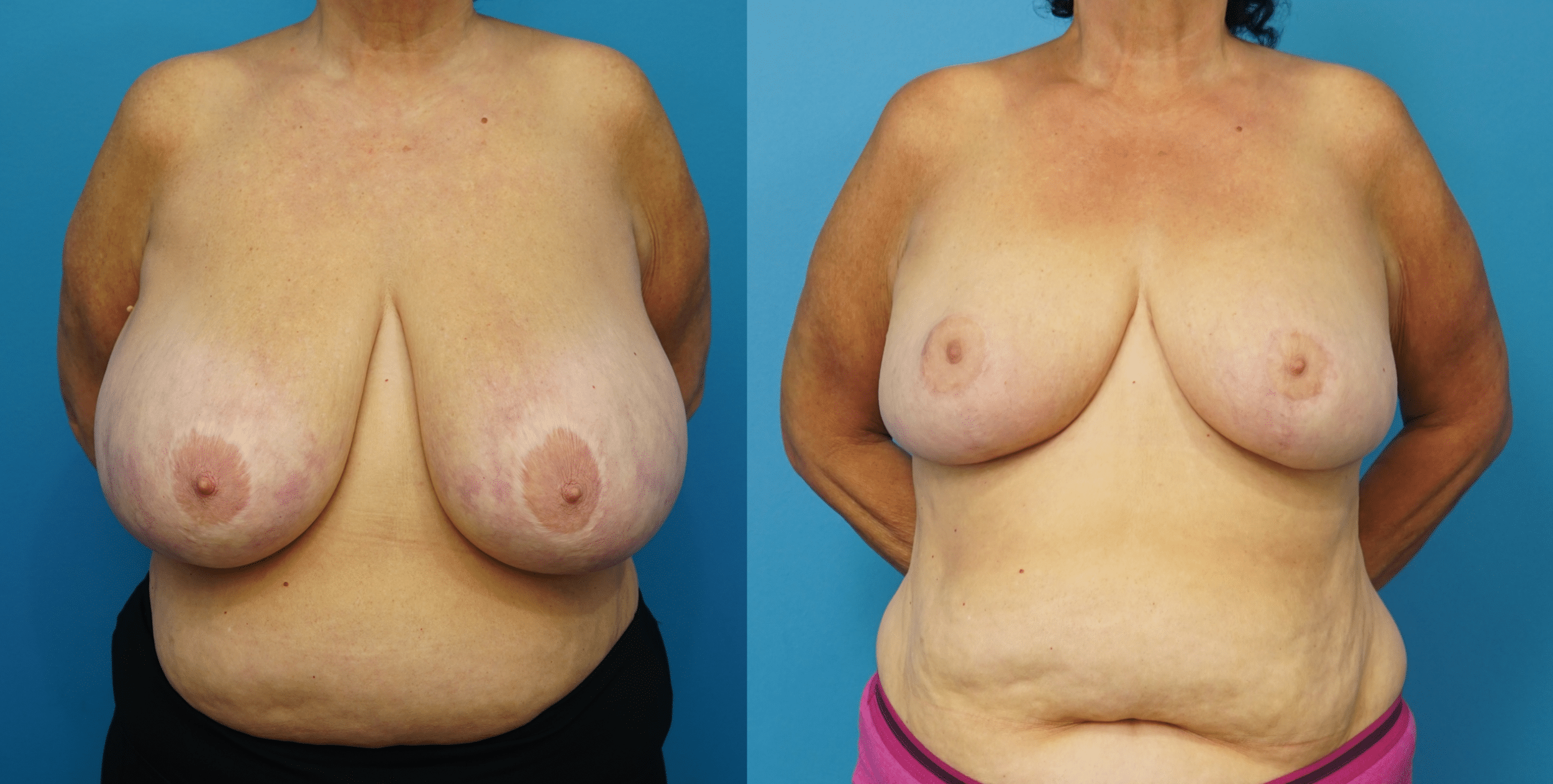 Before and After Image: Revision Breast Reduction - front