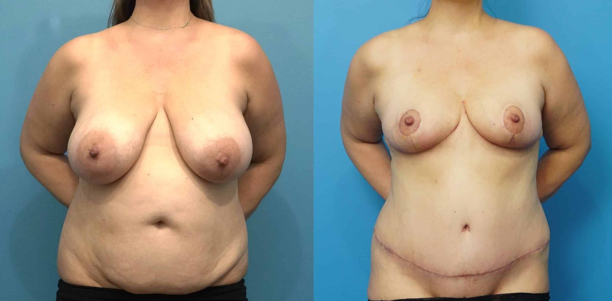 Before and After Image: Breast Reduction and Lift with Abdominoplasty and Flank Liposuction - front
