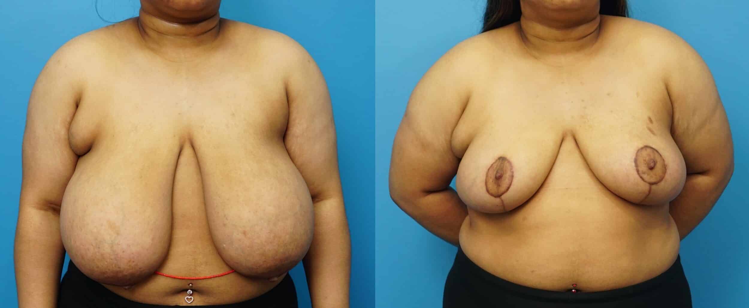 Before and After Image: Breast Reduction and Lift -