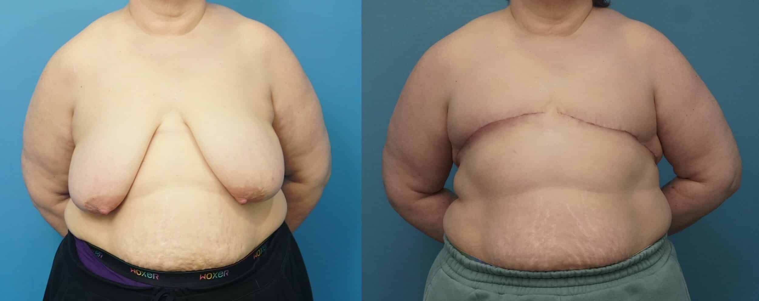 Before and After Image: Top Surgery with Aesthetic Flat Closure