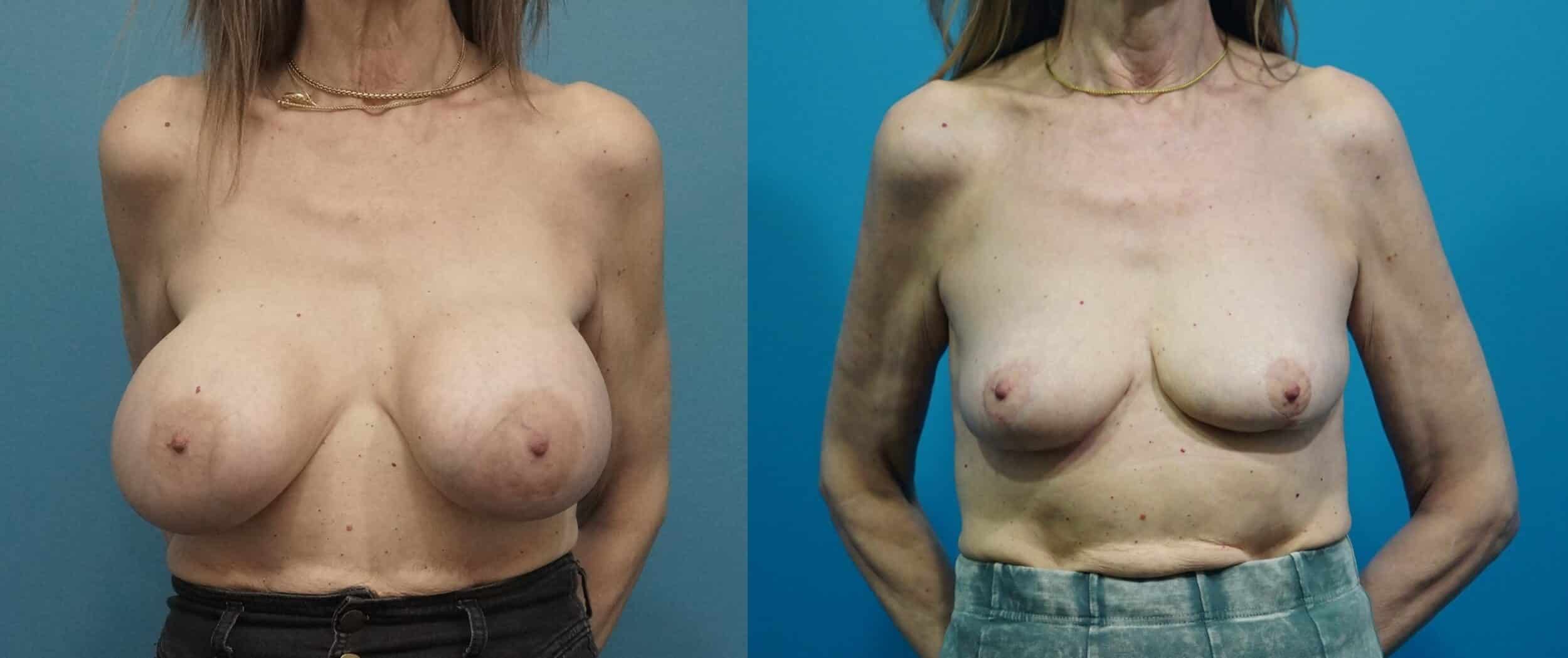 Before and After Image: Implant Removal and Lift - front