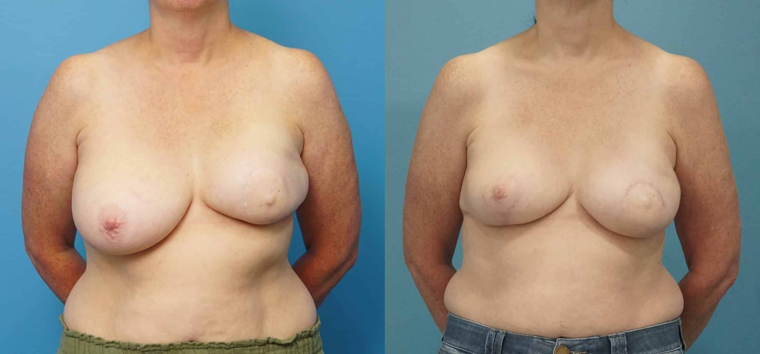 Before and After Image: Revision Reconstruction with Bilateral Lift - front