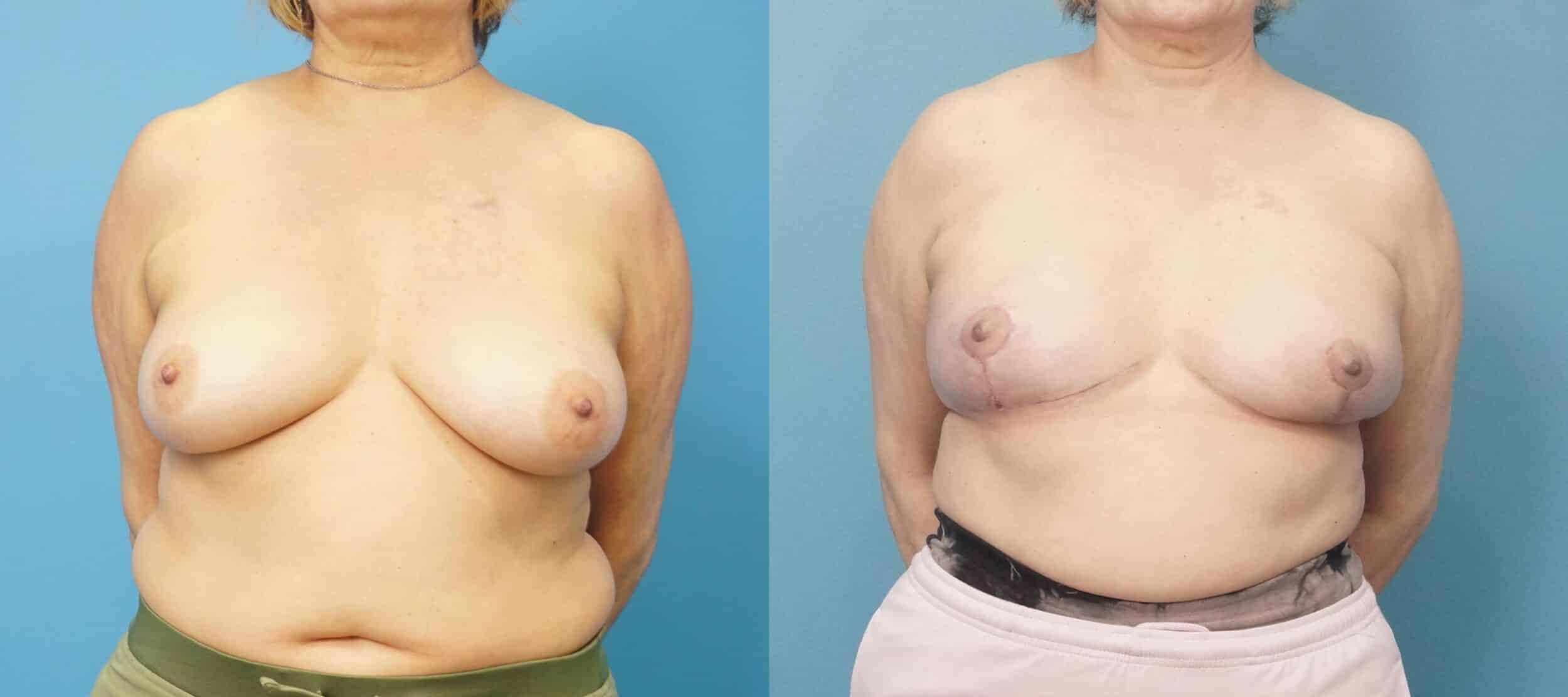 Before and After Image: Oncoplastic Breast Reduction