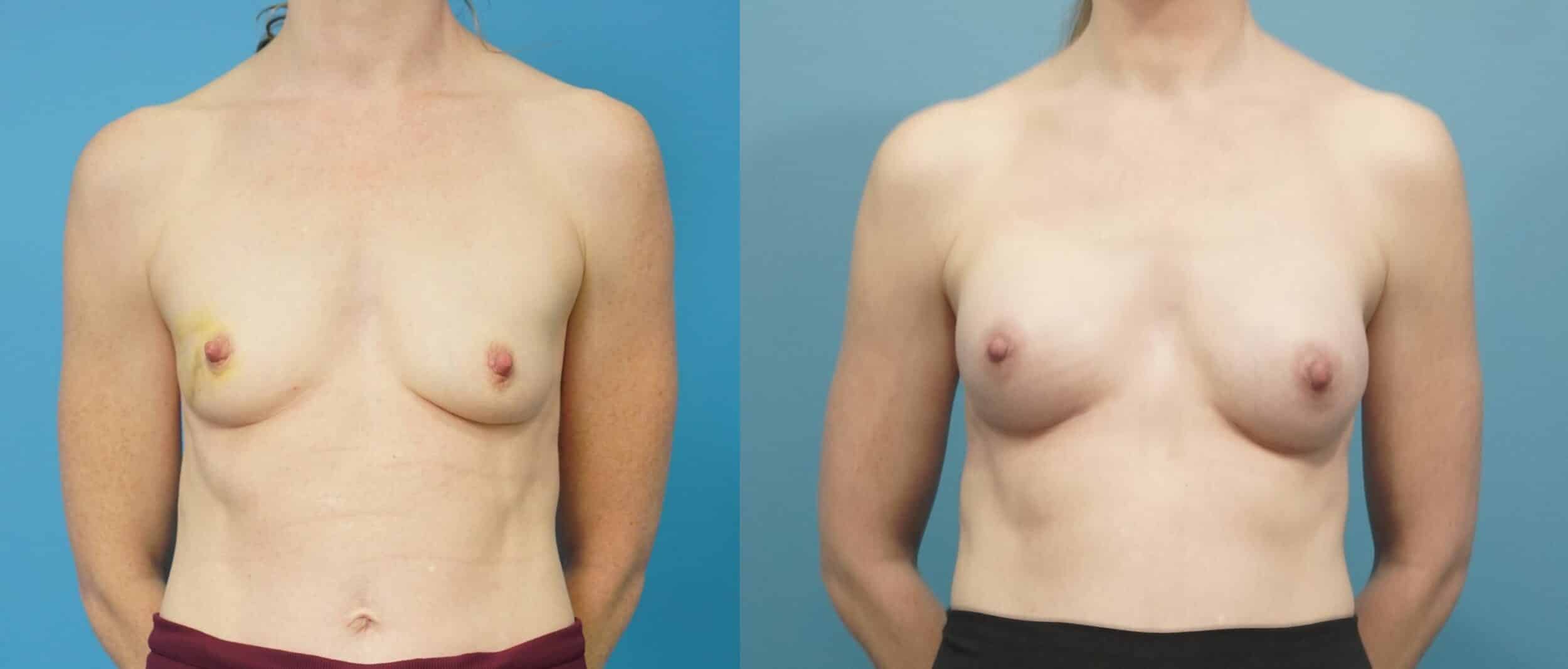 Before and After Image: Breast Reconstruction with Tissue Expander - front