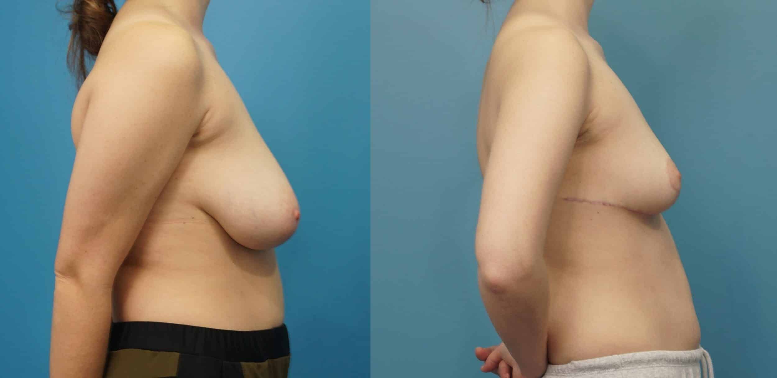 Before and After Image: Breast Reduction and Lift - right-side