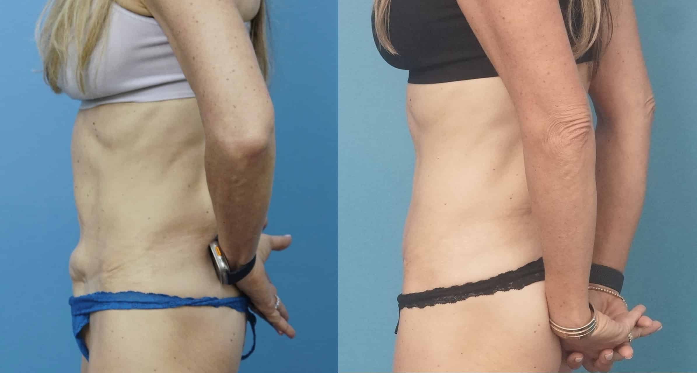 Before and After Image: Revision Abdominoplasty - left-side