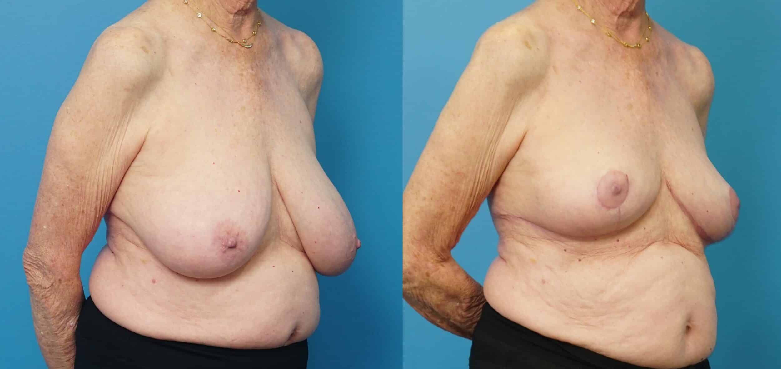 Before and After Image: Breast Reduction and Lift - right-front-oblique