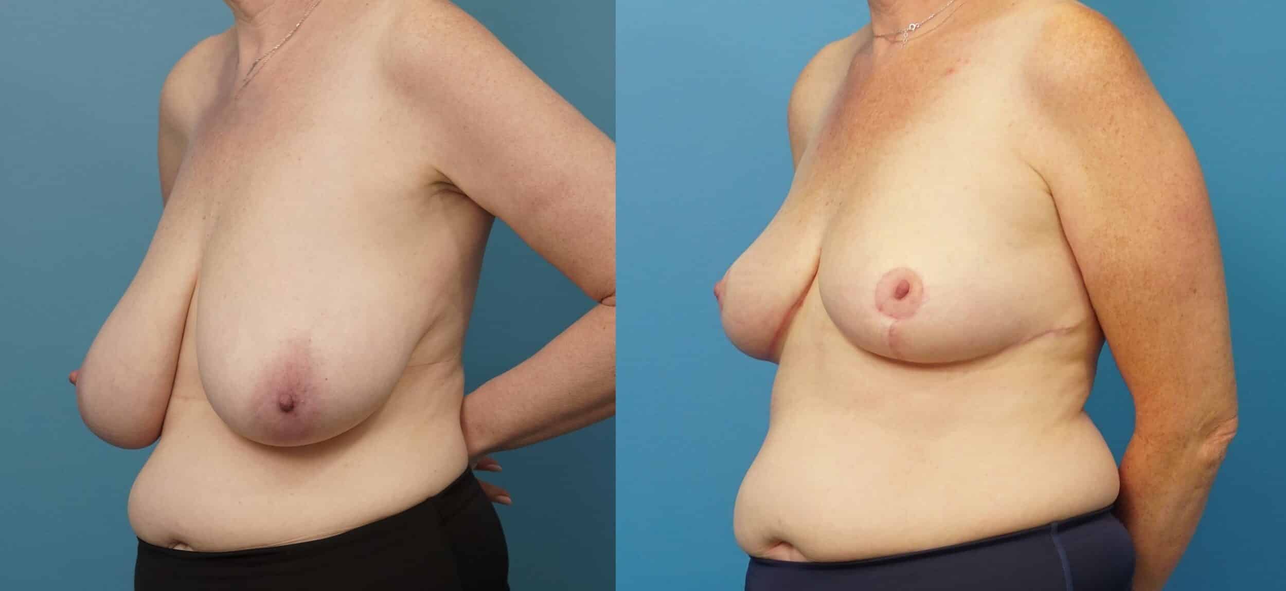 Before and After Image: Breast Reduction and Lift - left-front-oblique